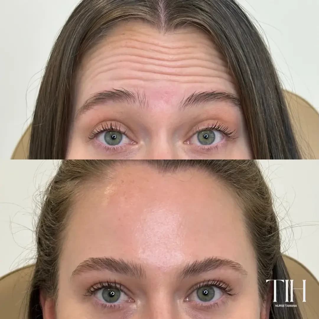 Before and after forehead neuromodulator treatment showing softened lines