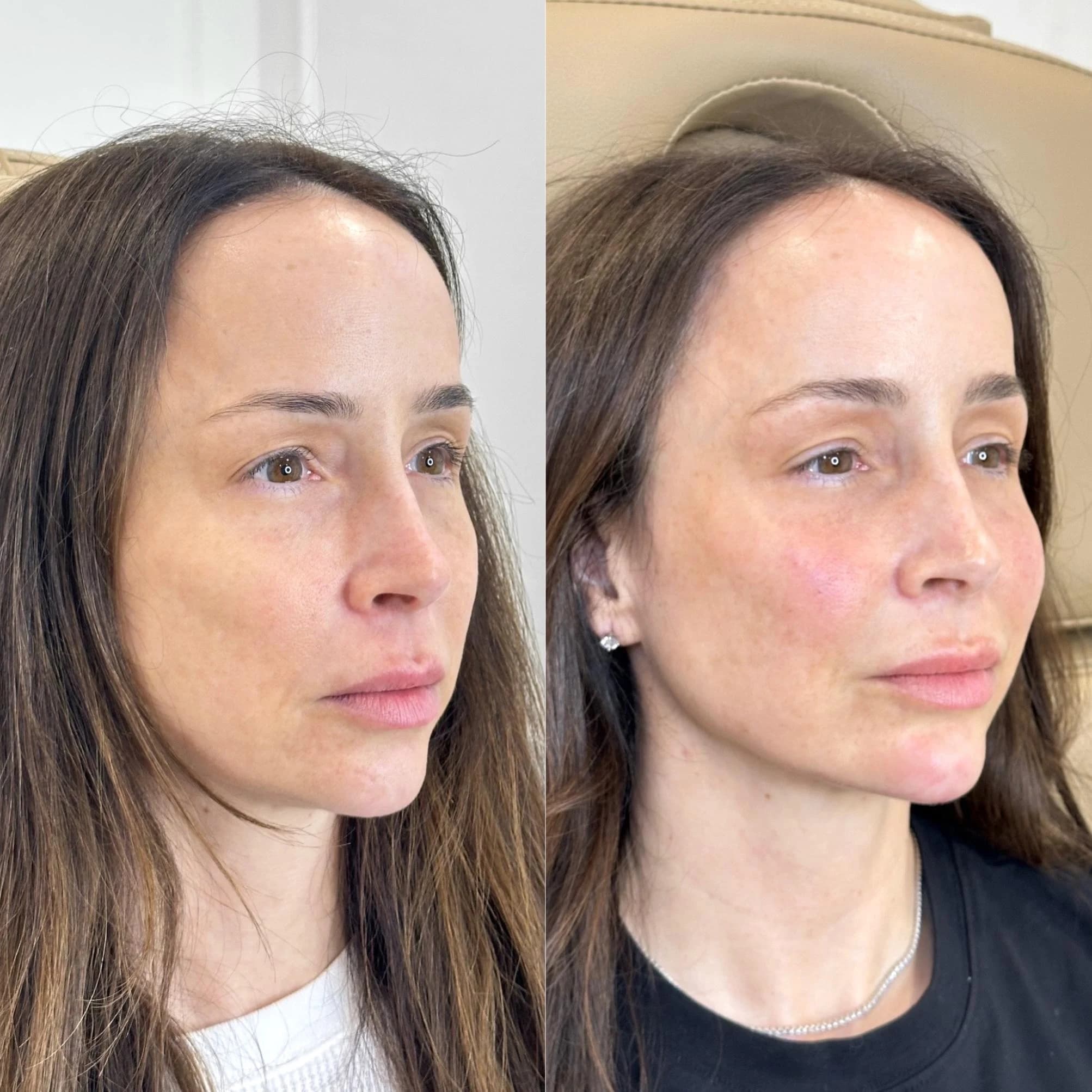 Before and after cheek filler — improved contour and facial balance
