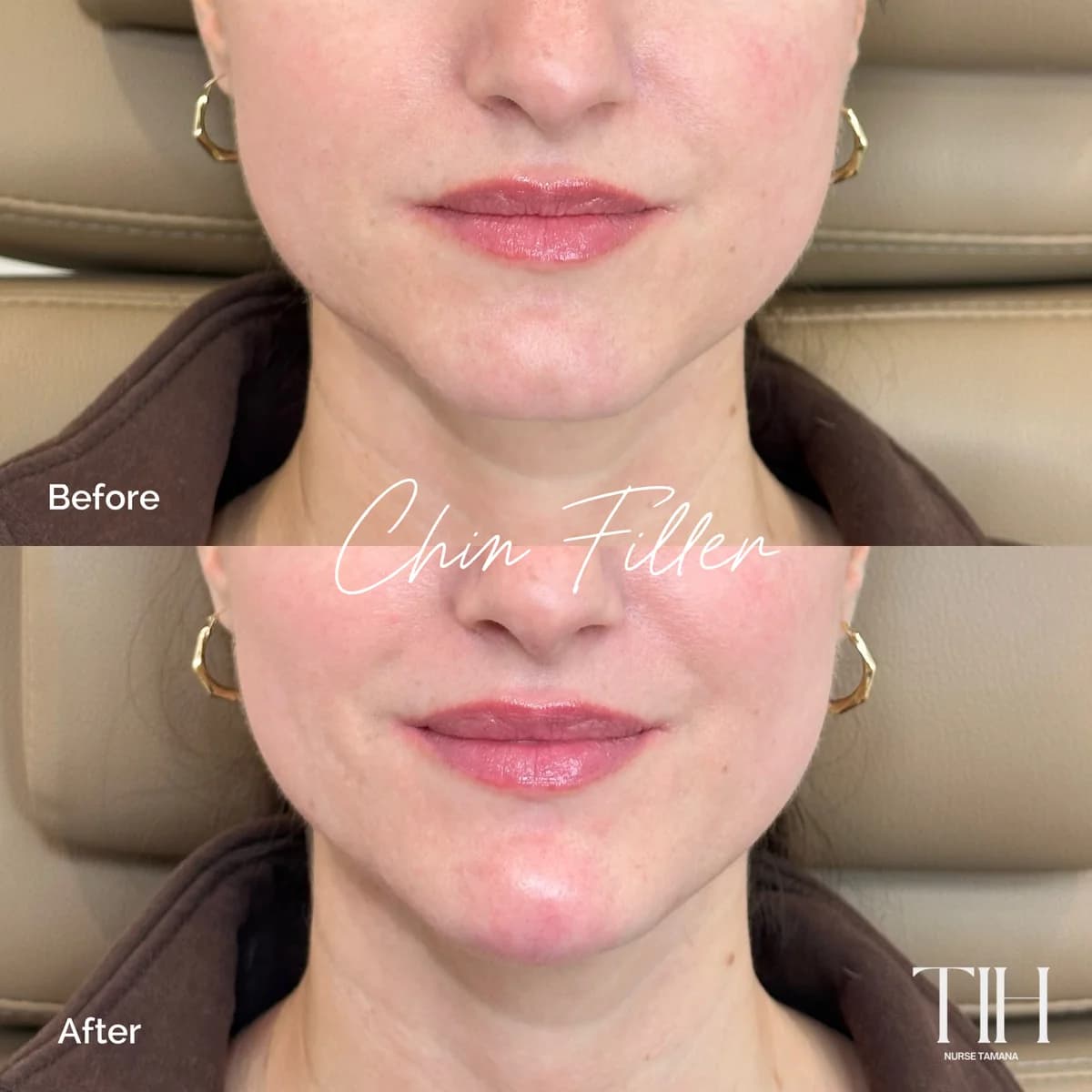 Before and after chin filler — frontal view showing facial proportion