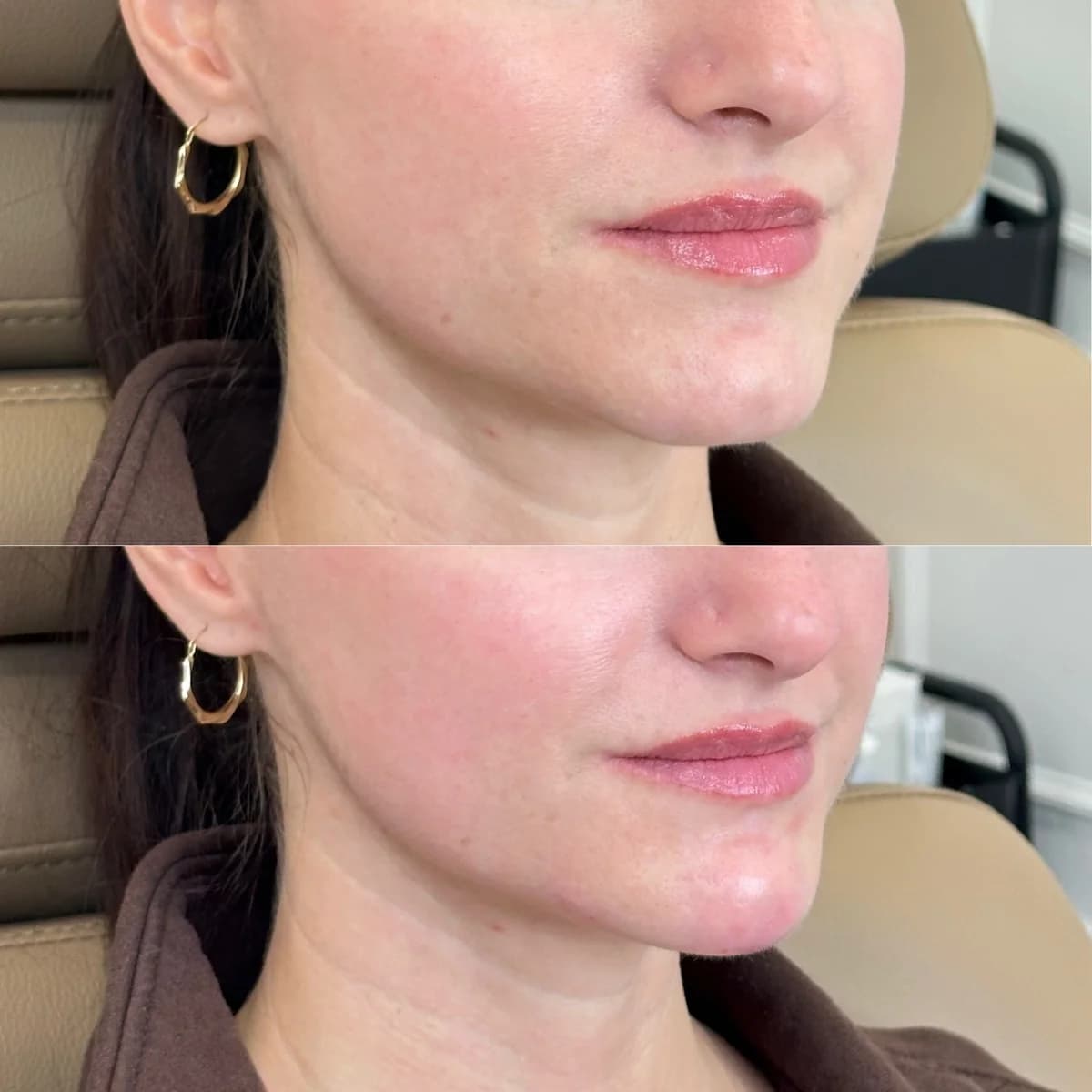 Before and after chin filler profile balancing