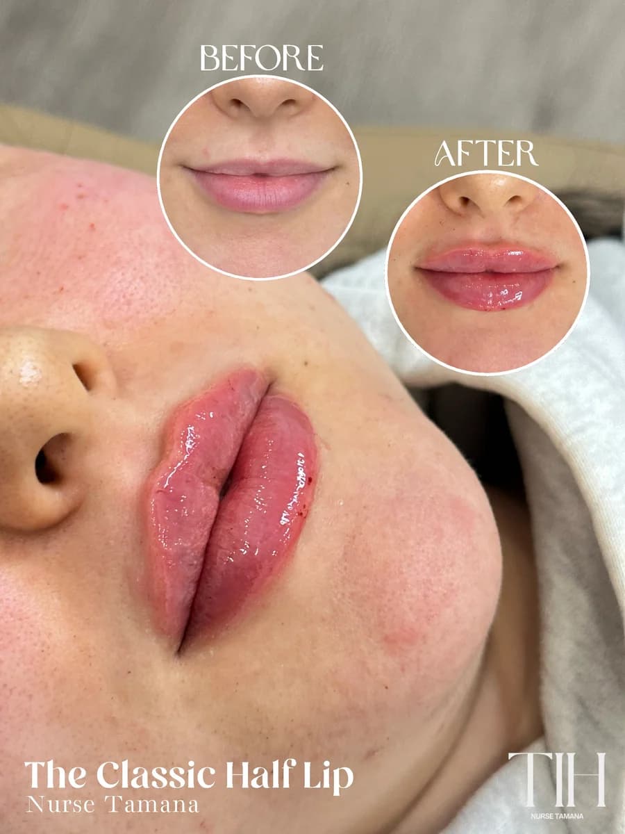 Before and after classic half-lip technique — upper lip definition