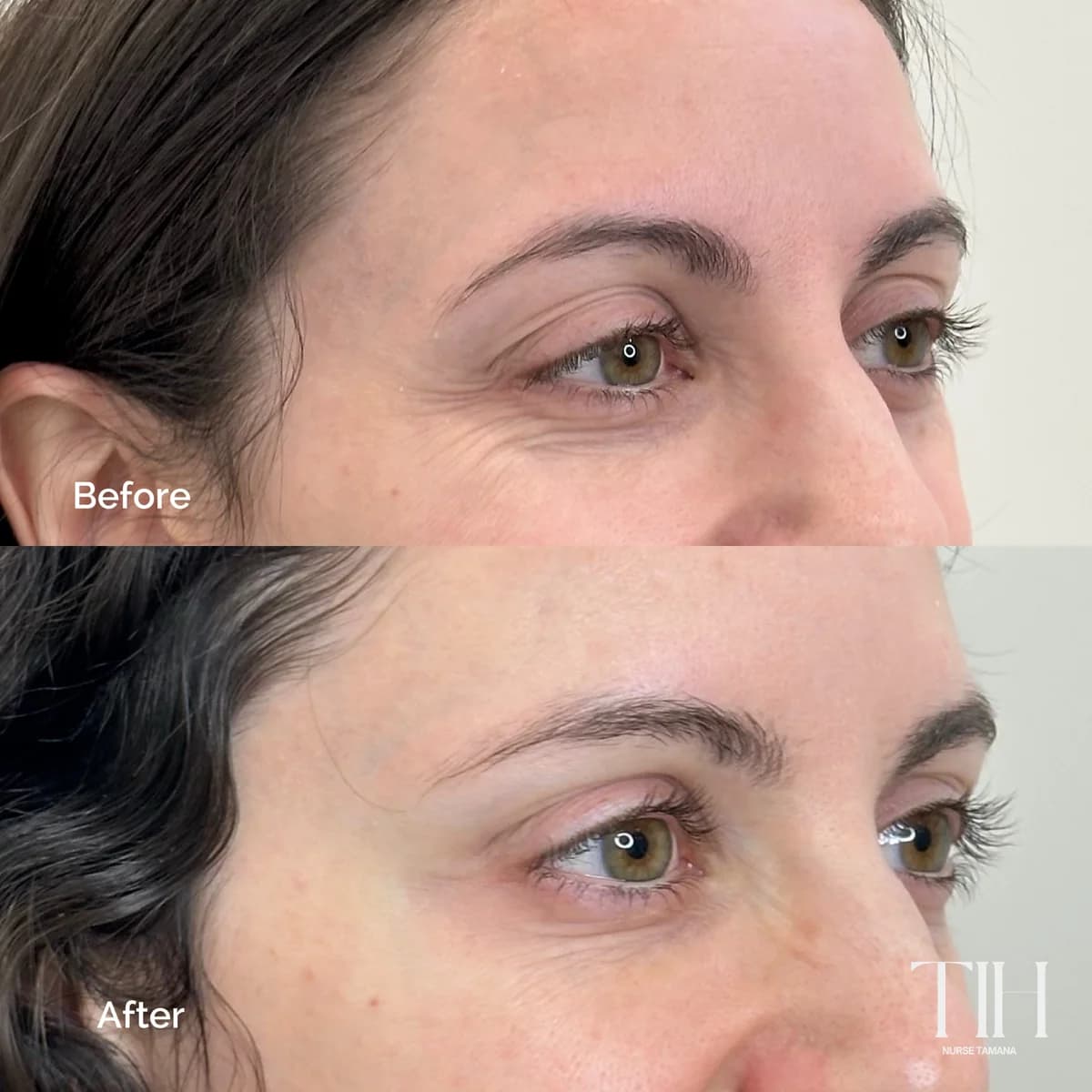 Before and after crow's feet treatment — softened outer-eye lines
