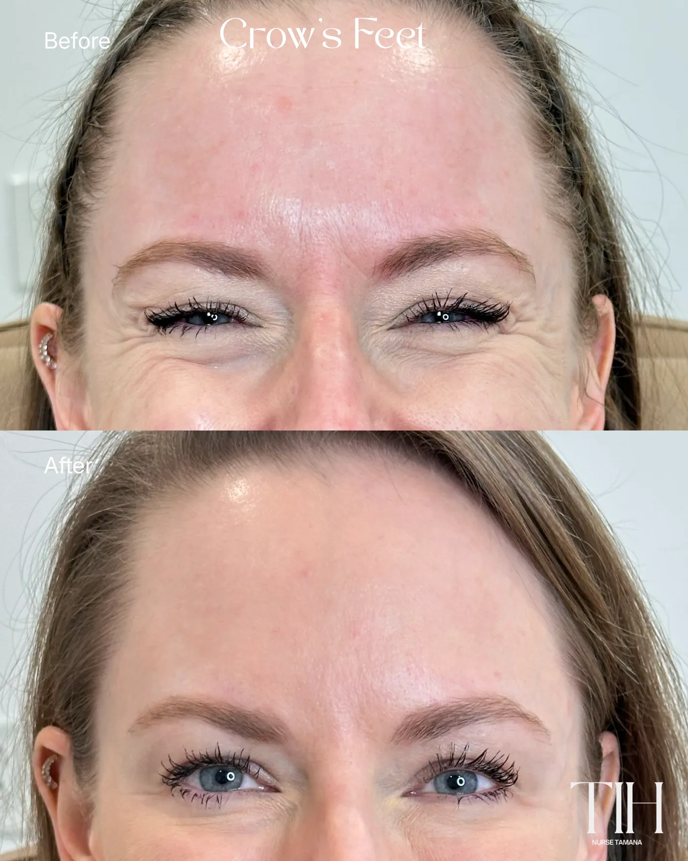 Before and after crow's feet treatment — softened lines around the eyes