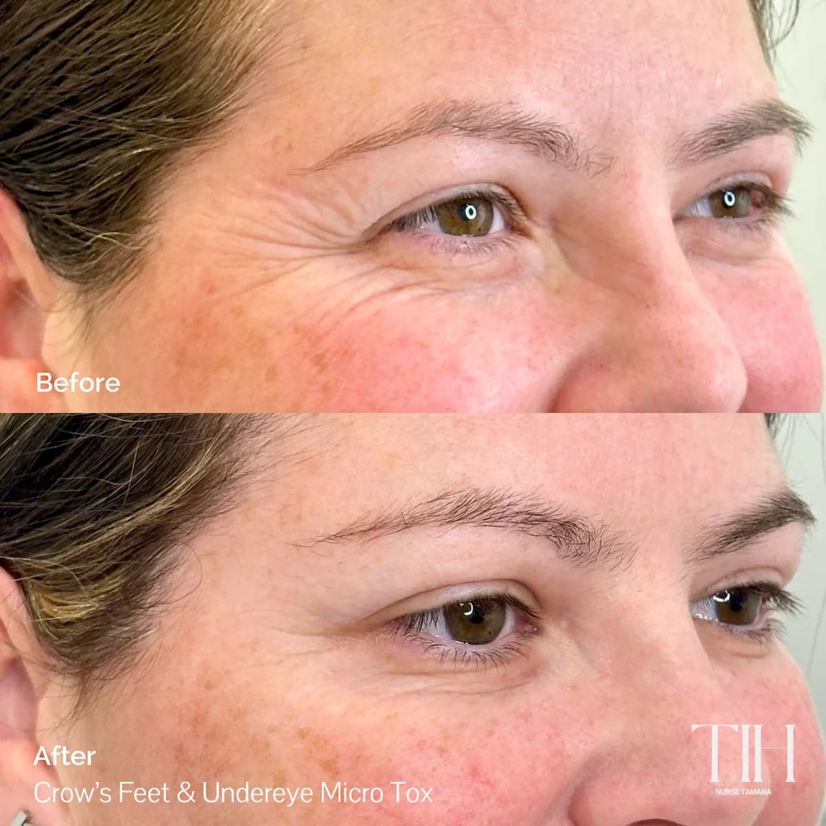 Before and after crow's feet and under-eye — refreshed eye area