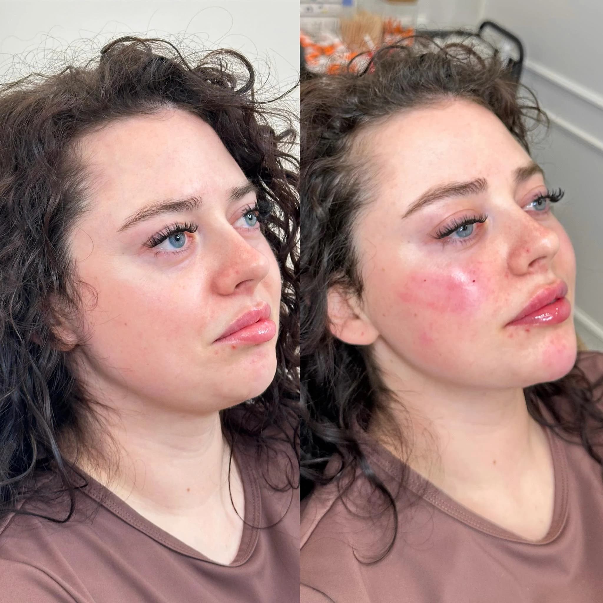 Facial Balancing at The Injectable Haus
