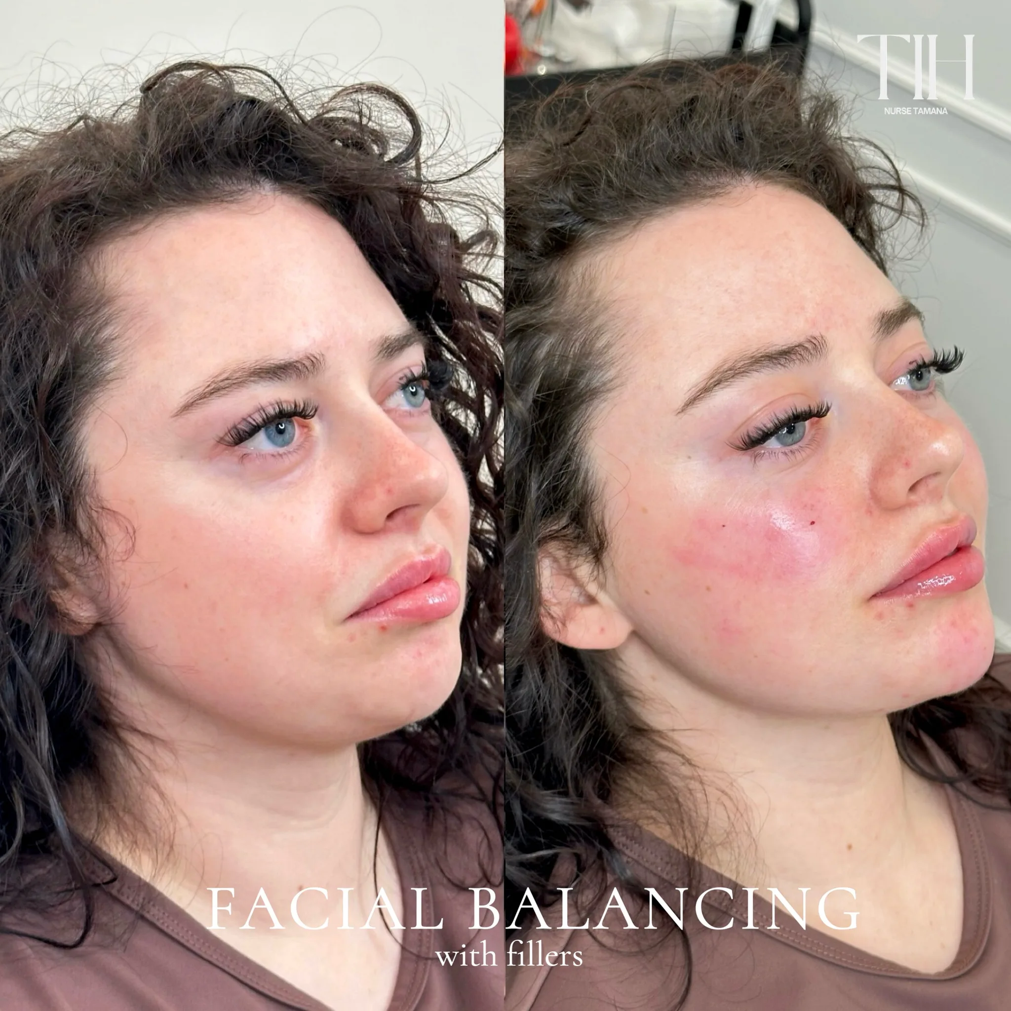 Before and after facial balancing with fillers, showing cheek and profile refinement