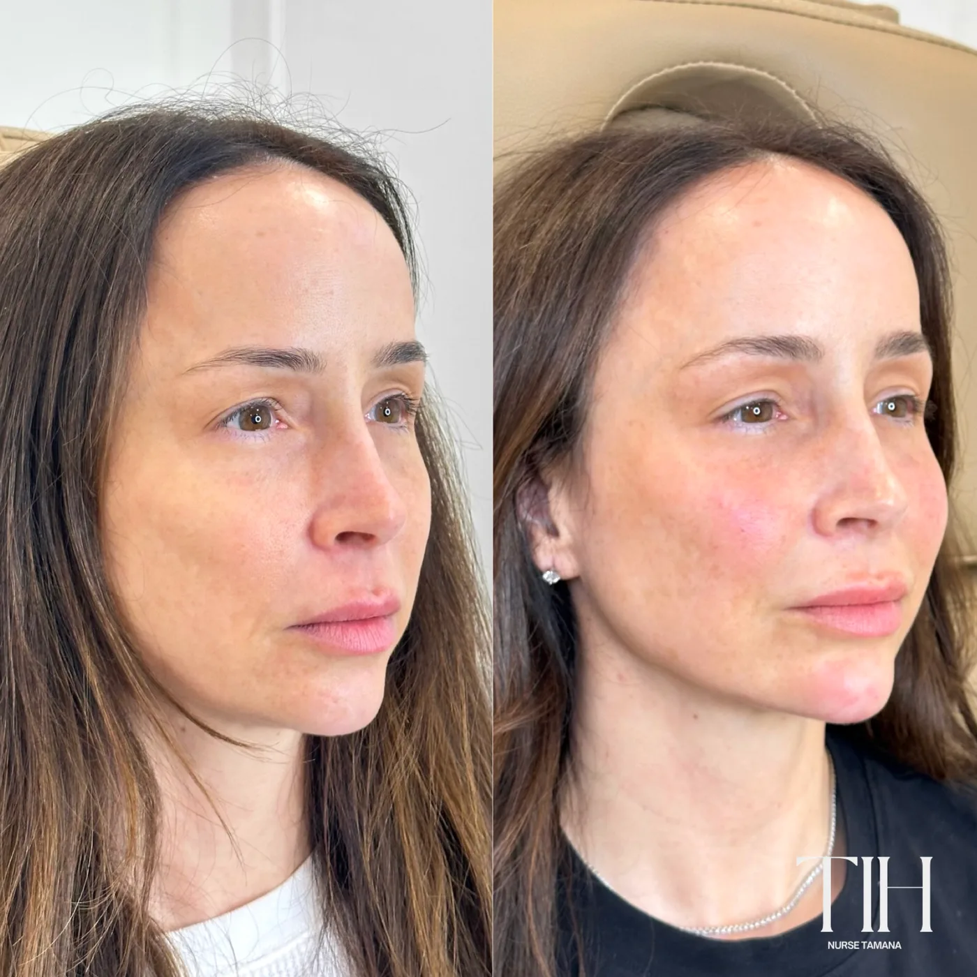 Before and after facial balancing — refined profile and softened features