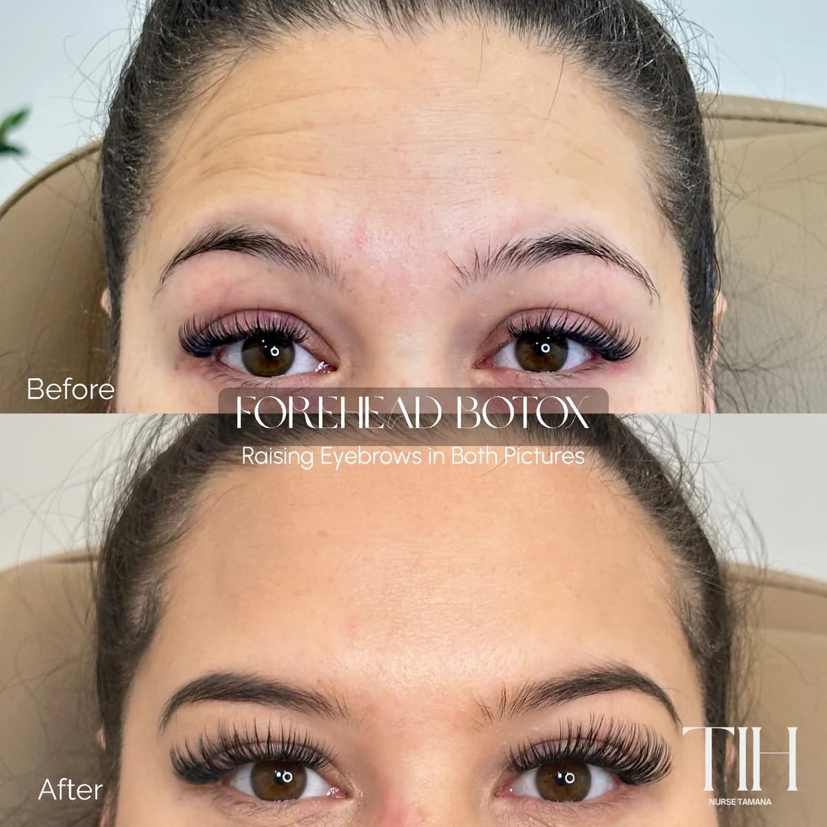 Before and after forehead neuromodulator — softened horizontal lines