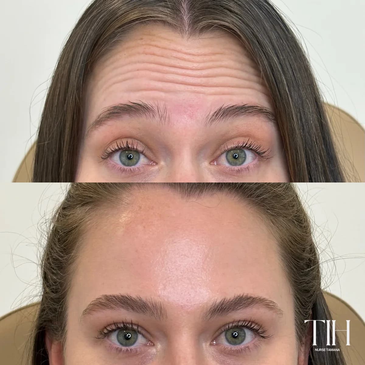 Before and after forehead neuromodulator — softened expression lines
