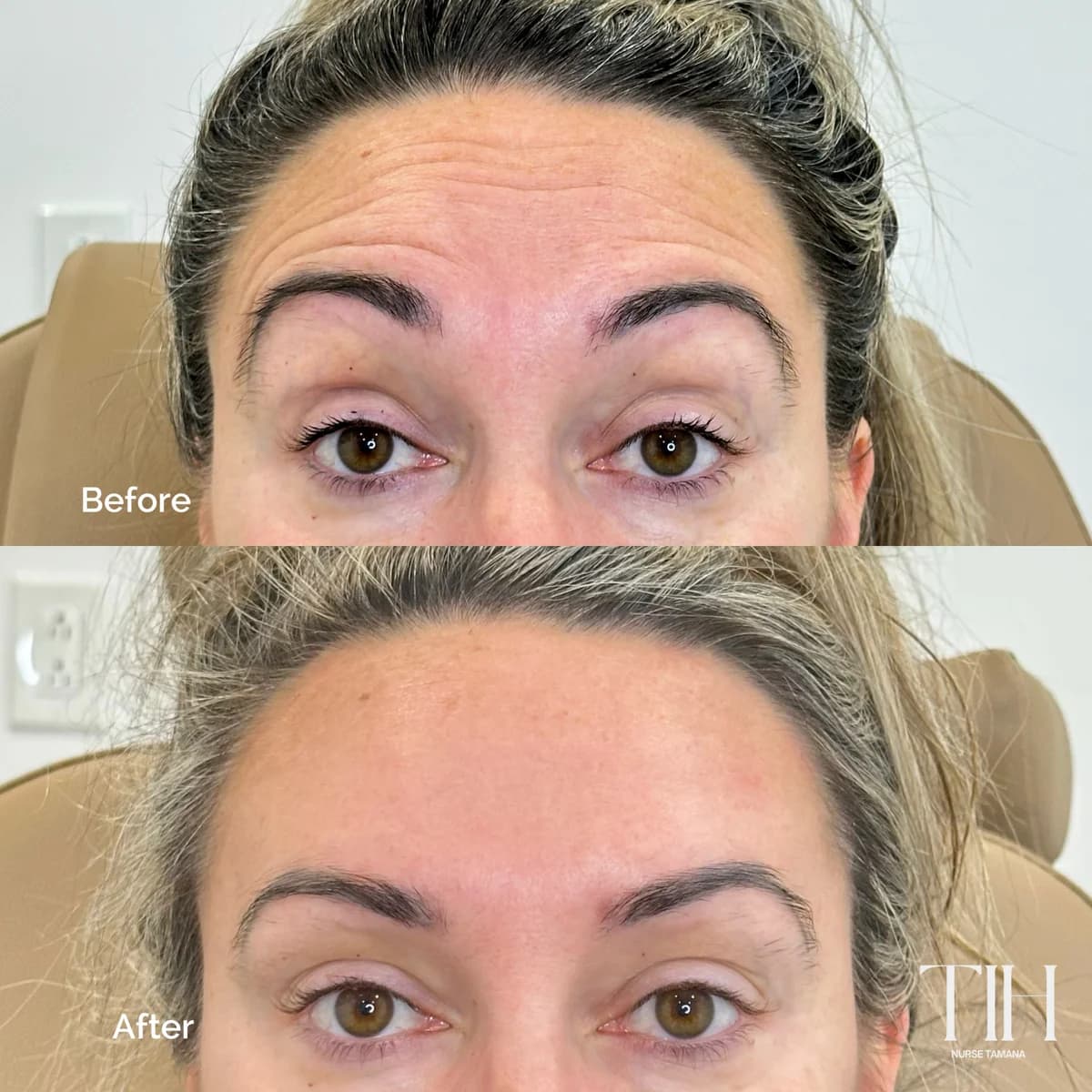Before and after forehead lines — softened expression lines