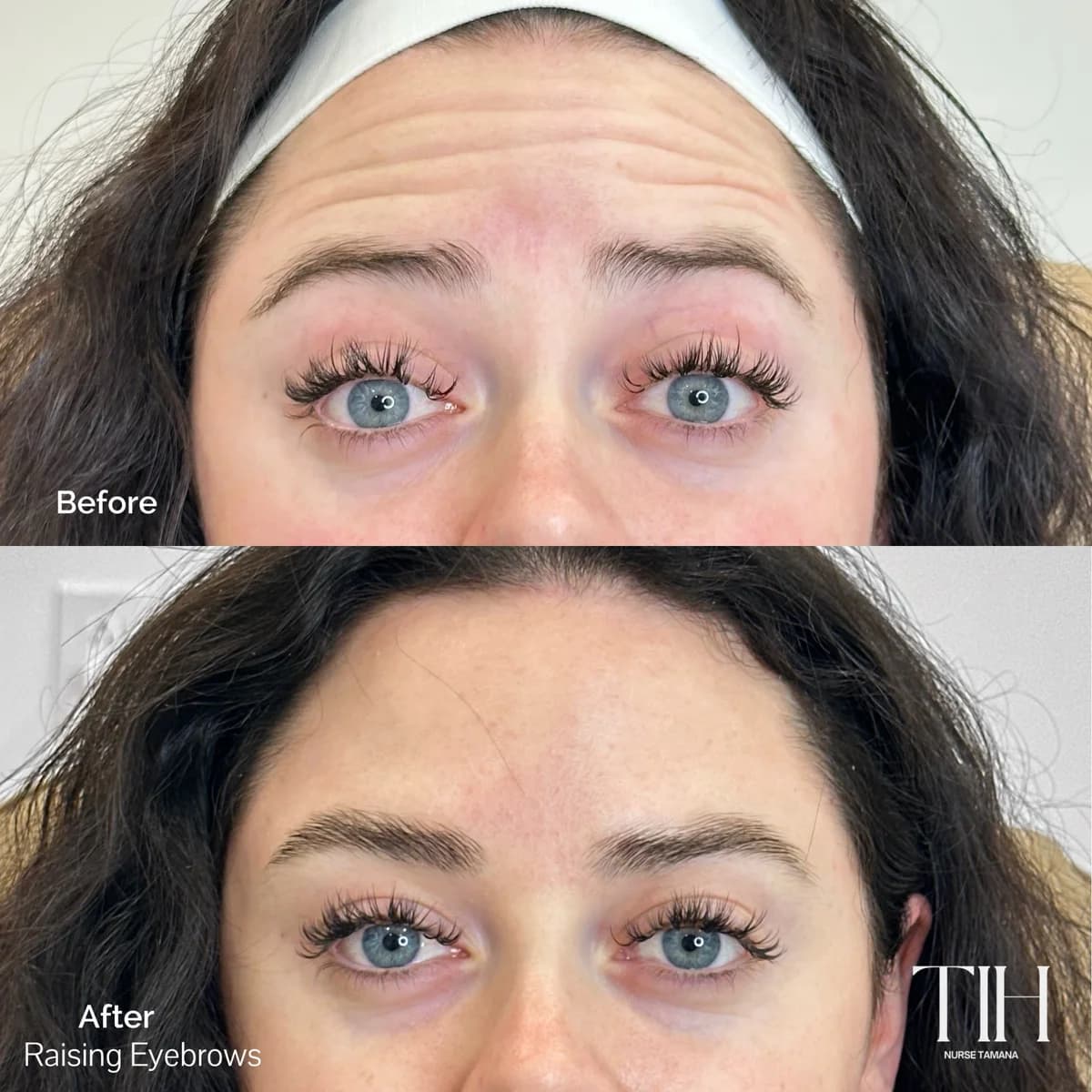 Before and after forehead lines — refreshed, softened forehead