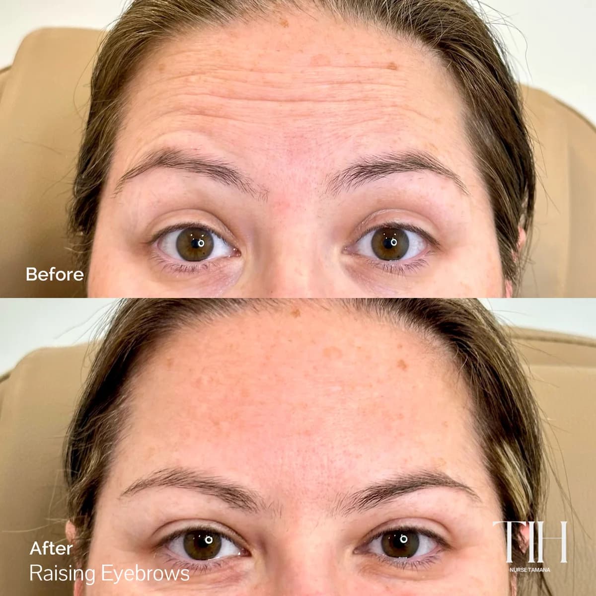 Before and after forehead lines — smoother skin while raising the eyebrows