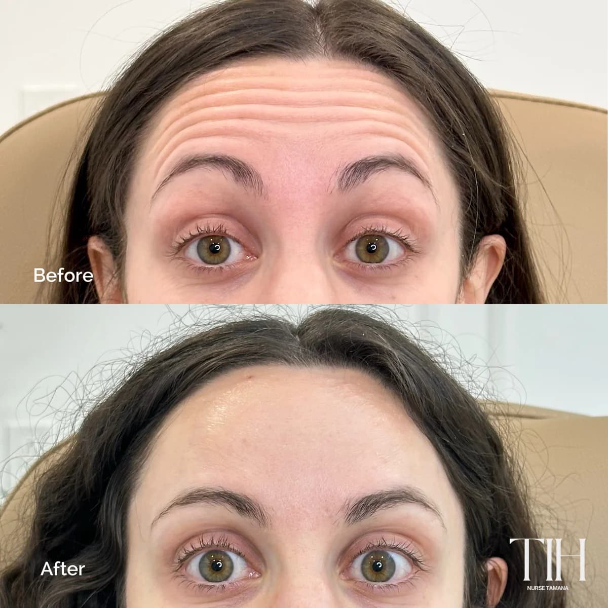 Before and after forehead wrinkle treatment showing smoothed lines
