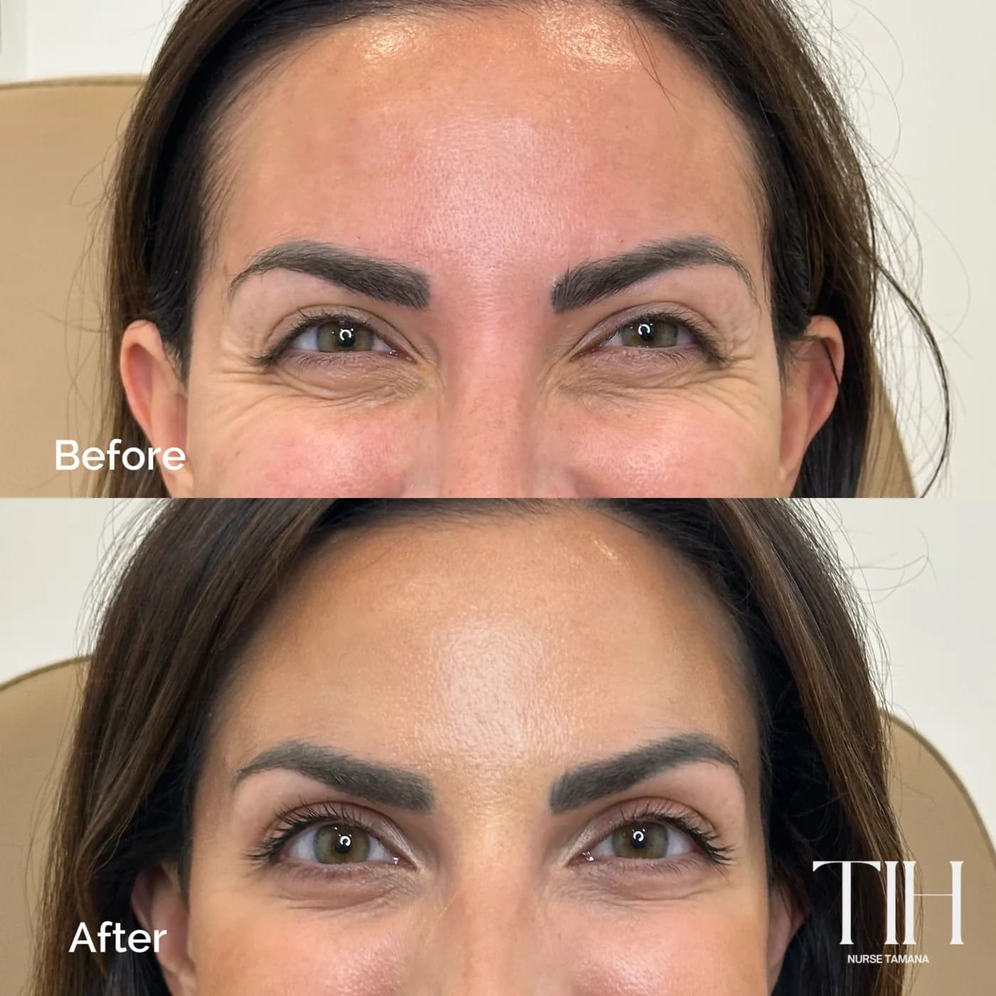 Before and after forehead and brow Botox — smoothed lines with natural movement