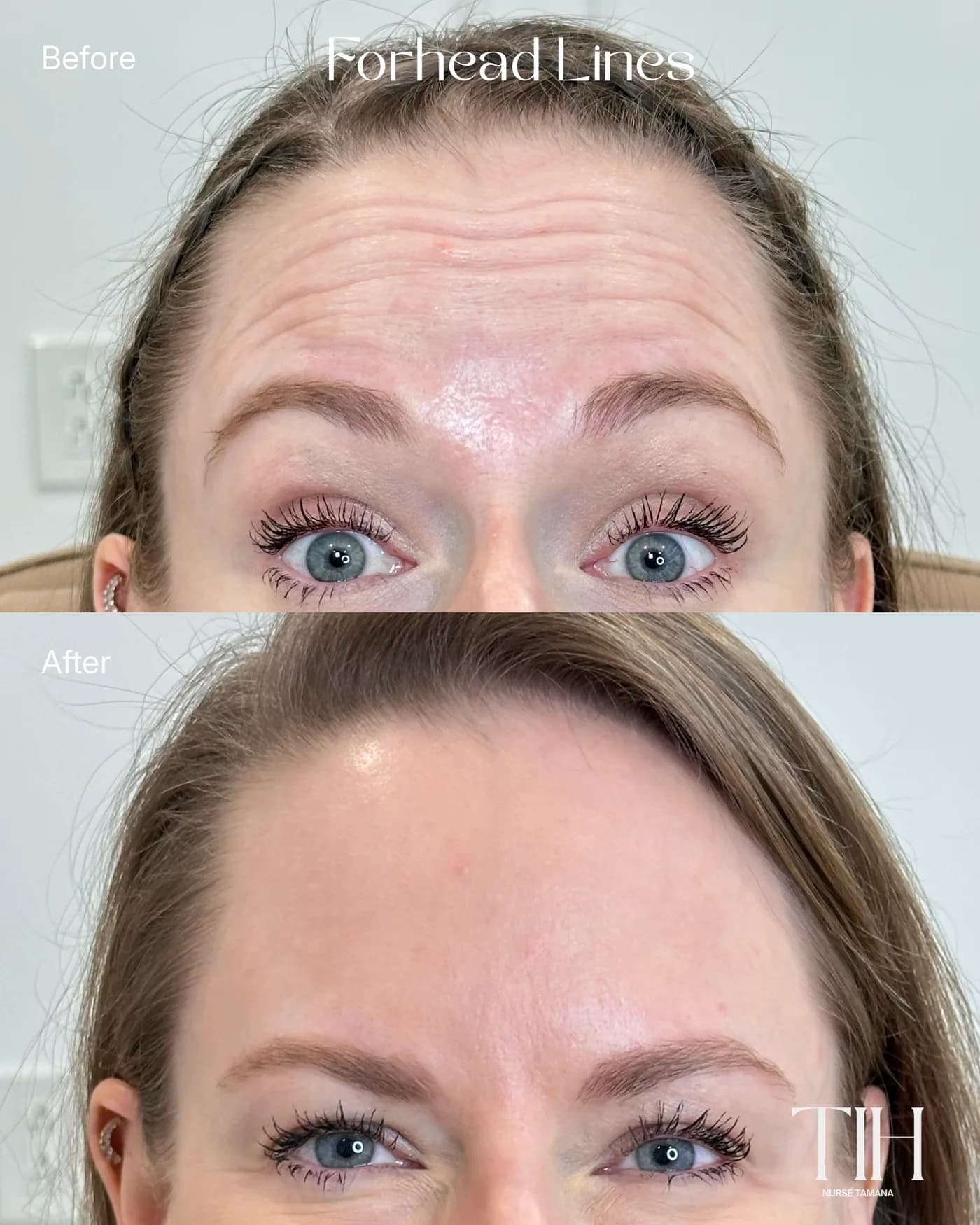 Before and after forehead lines — smoother, refreshed forehead
