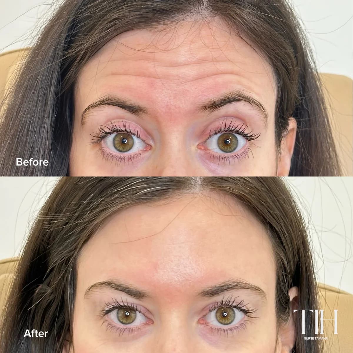 Before and after forehead lines in motion — smoother horizontal lines