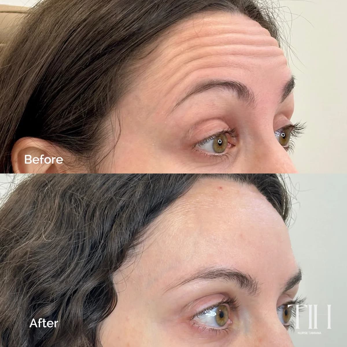 Before and after forehead lines — profile view with softened expression lines