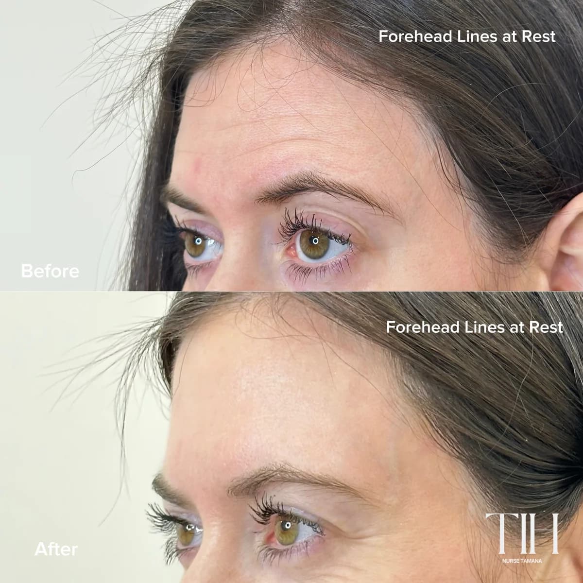 Before and after forehead lines at rest — smoother forehead texture