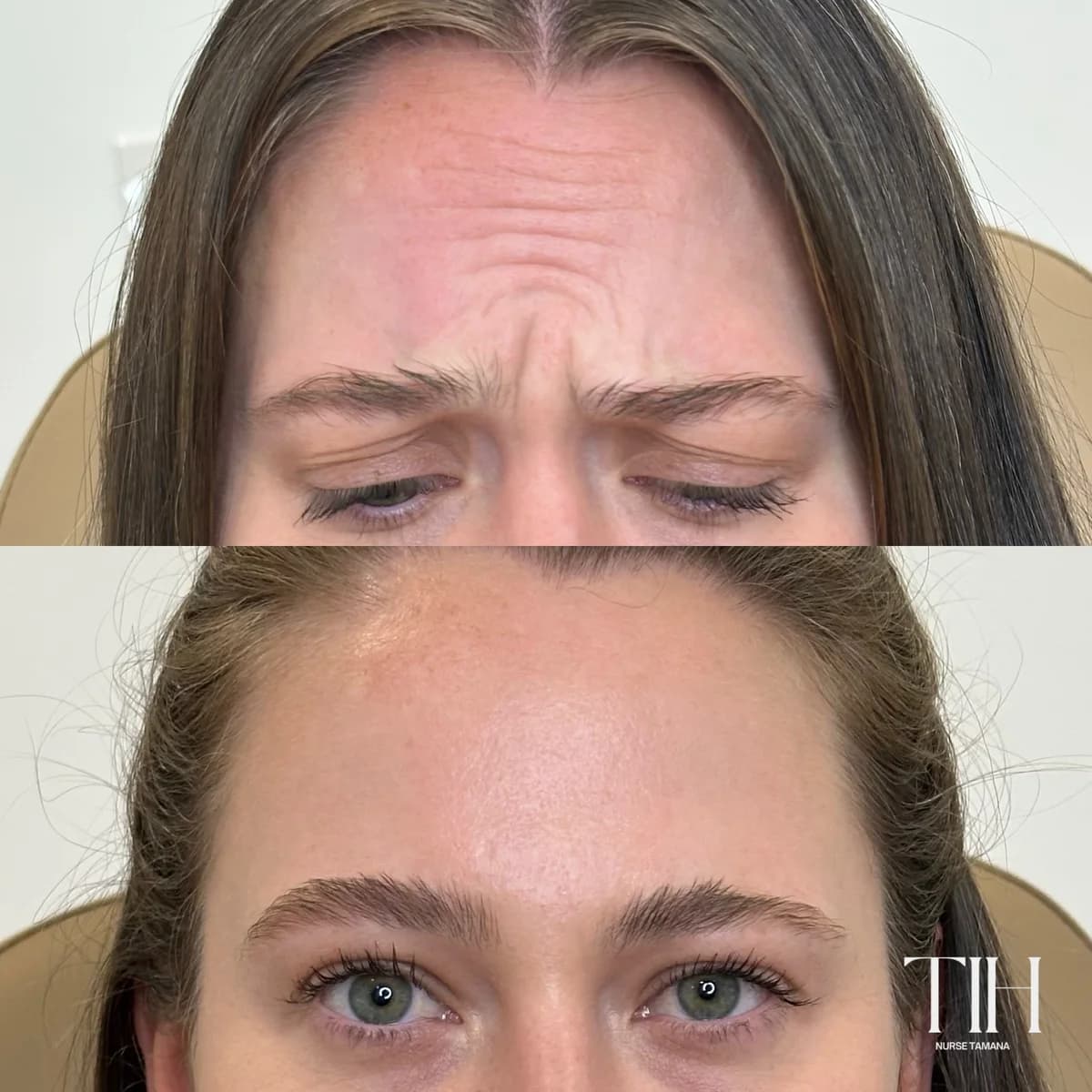 Before and after frown lines treatment — softened brow tension