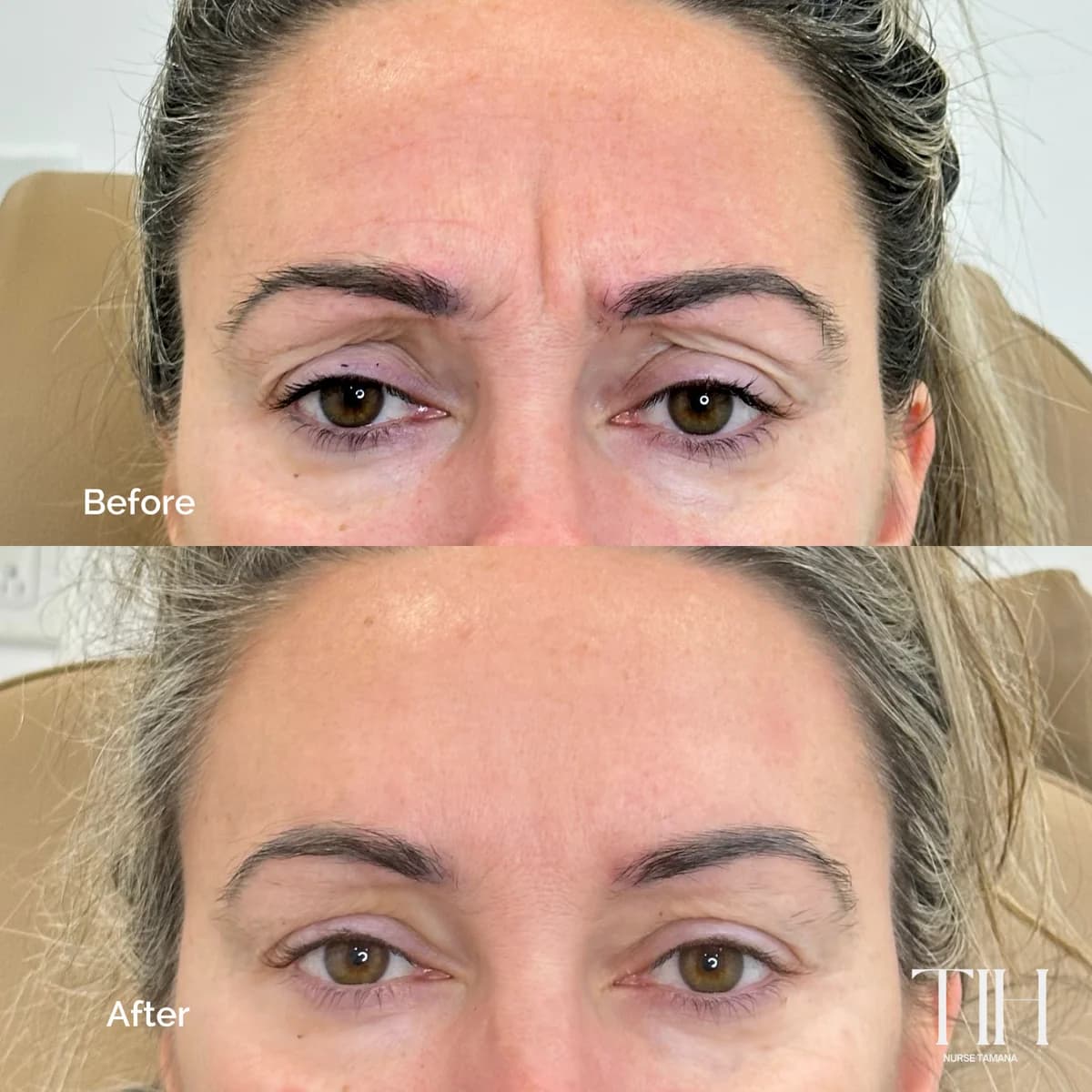 Before and after frown lines — reduced 11 lines between brows