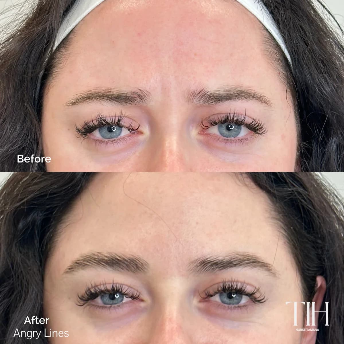 Before and after frown lines — natural-looking brow relaxation