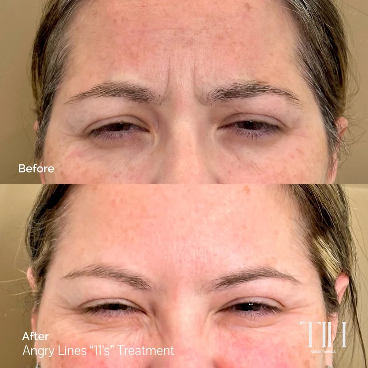Before and after frown lines — softened 11 lines between the brows