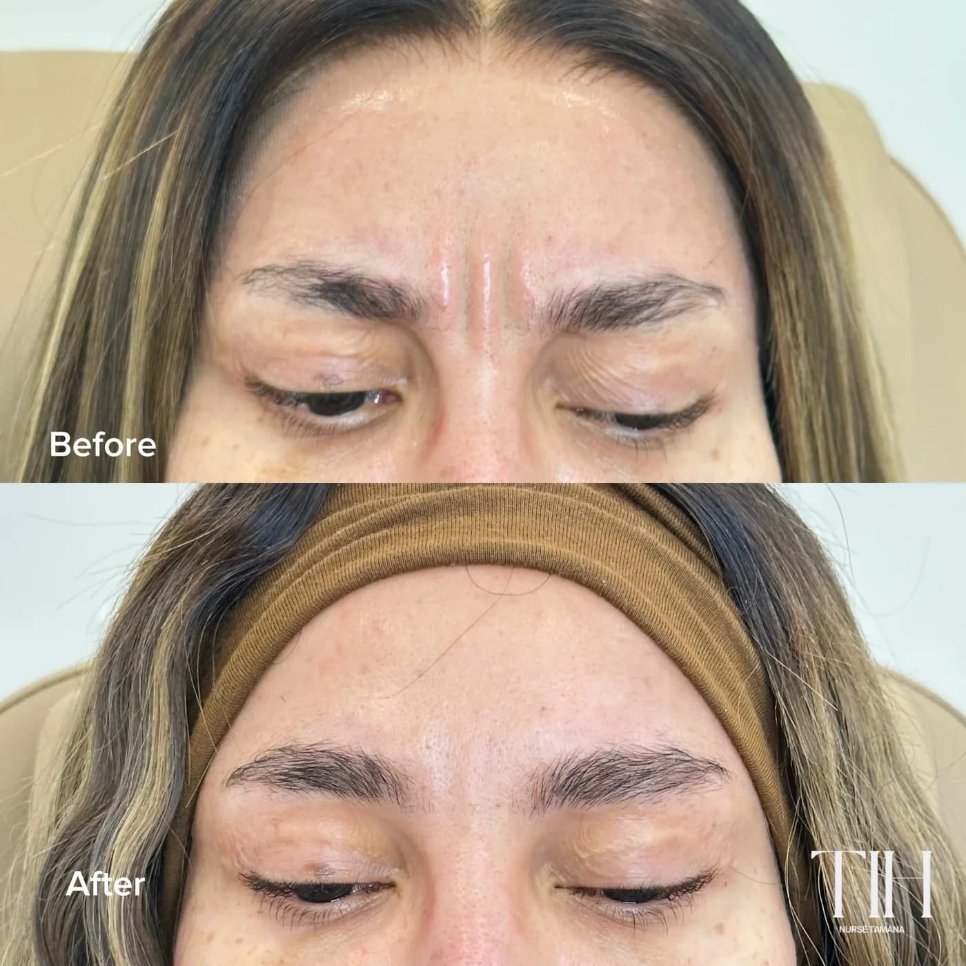 Before and after frown lines — smoothed glabella lines between the brows