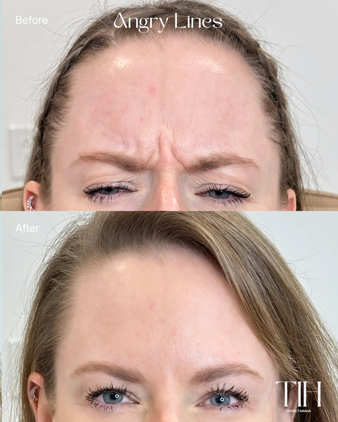 Before and after frown lines neuromodulator — smoothed glabella lines