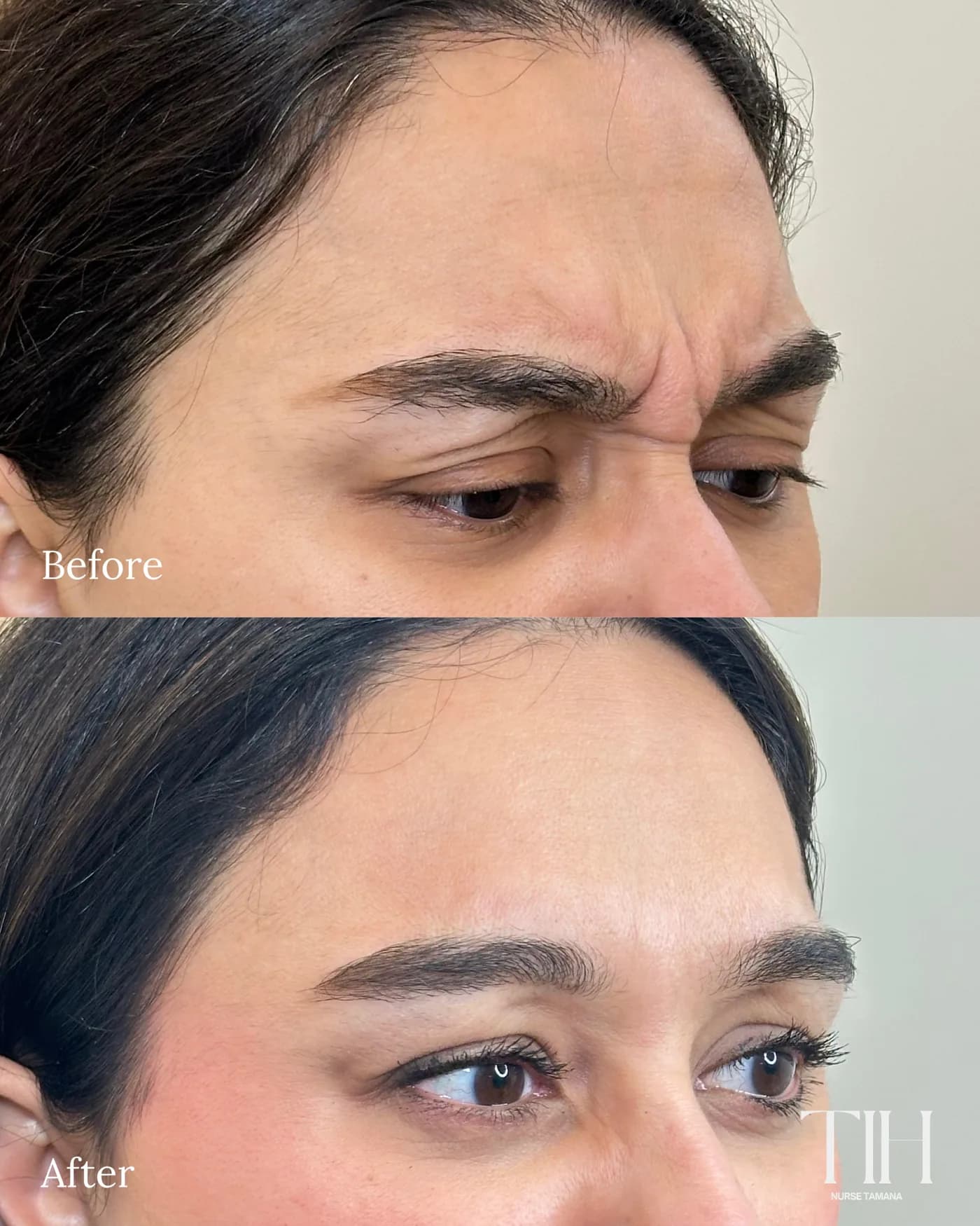 Before and after frown lines — angled view showing softened glabella lines
