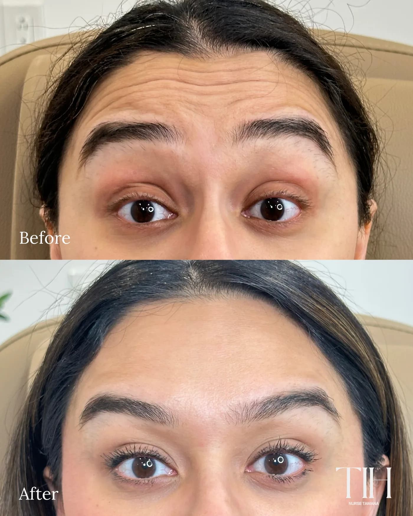 Before and after frown lines — smoother, refreshed forehead and brow area