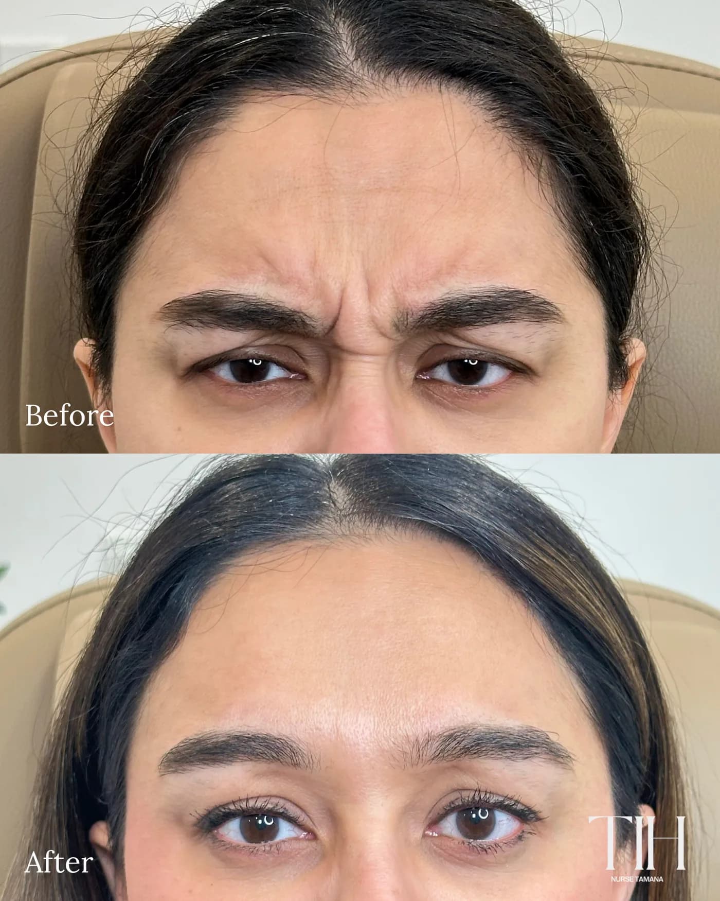 Before and after frown lines — smoothed deep glabella creases