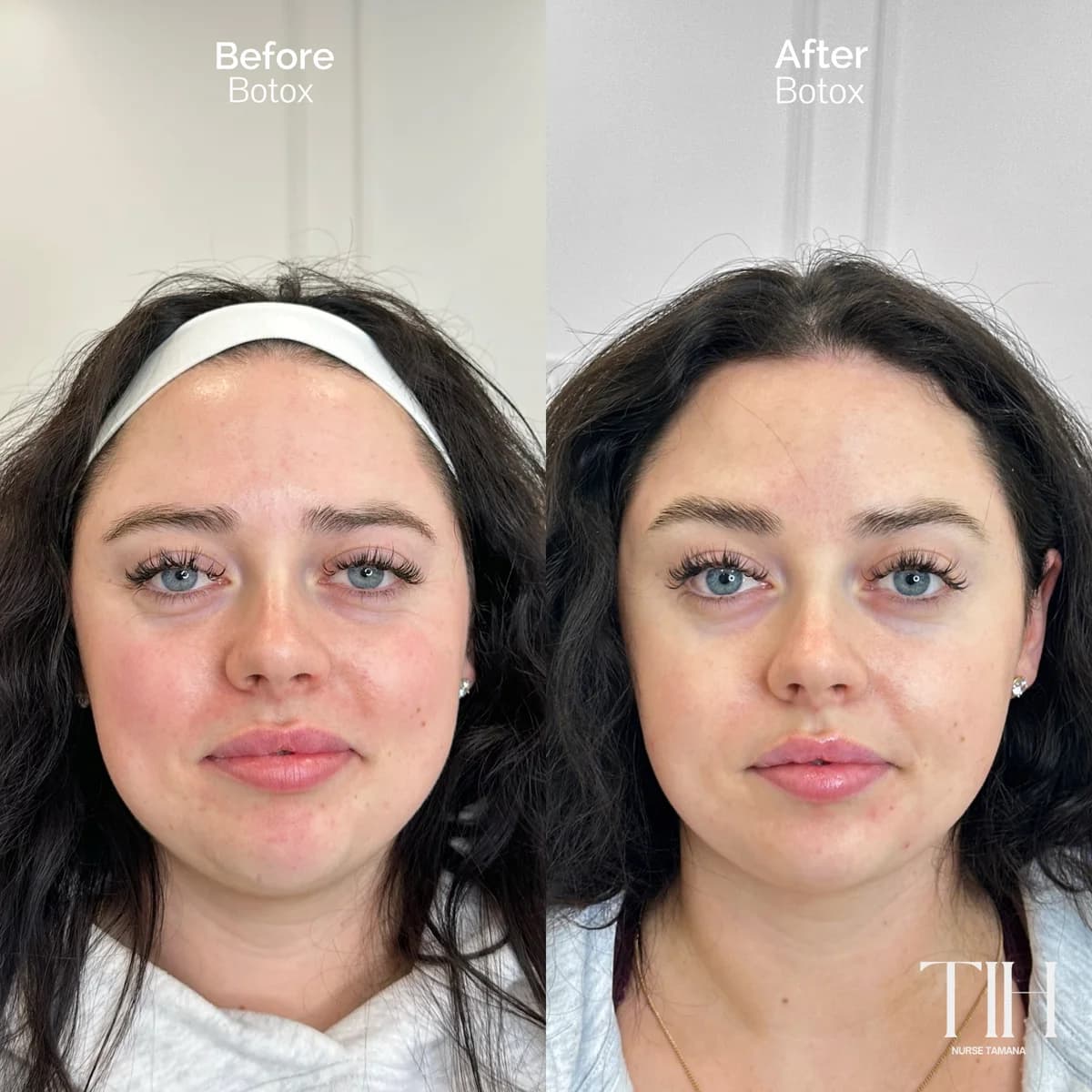 Before and after full-face Botox — smoother, refreshed appearance