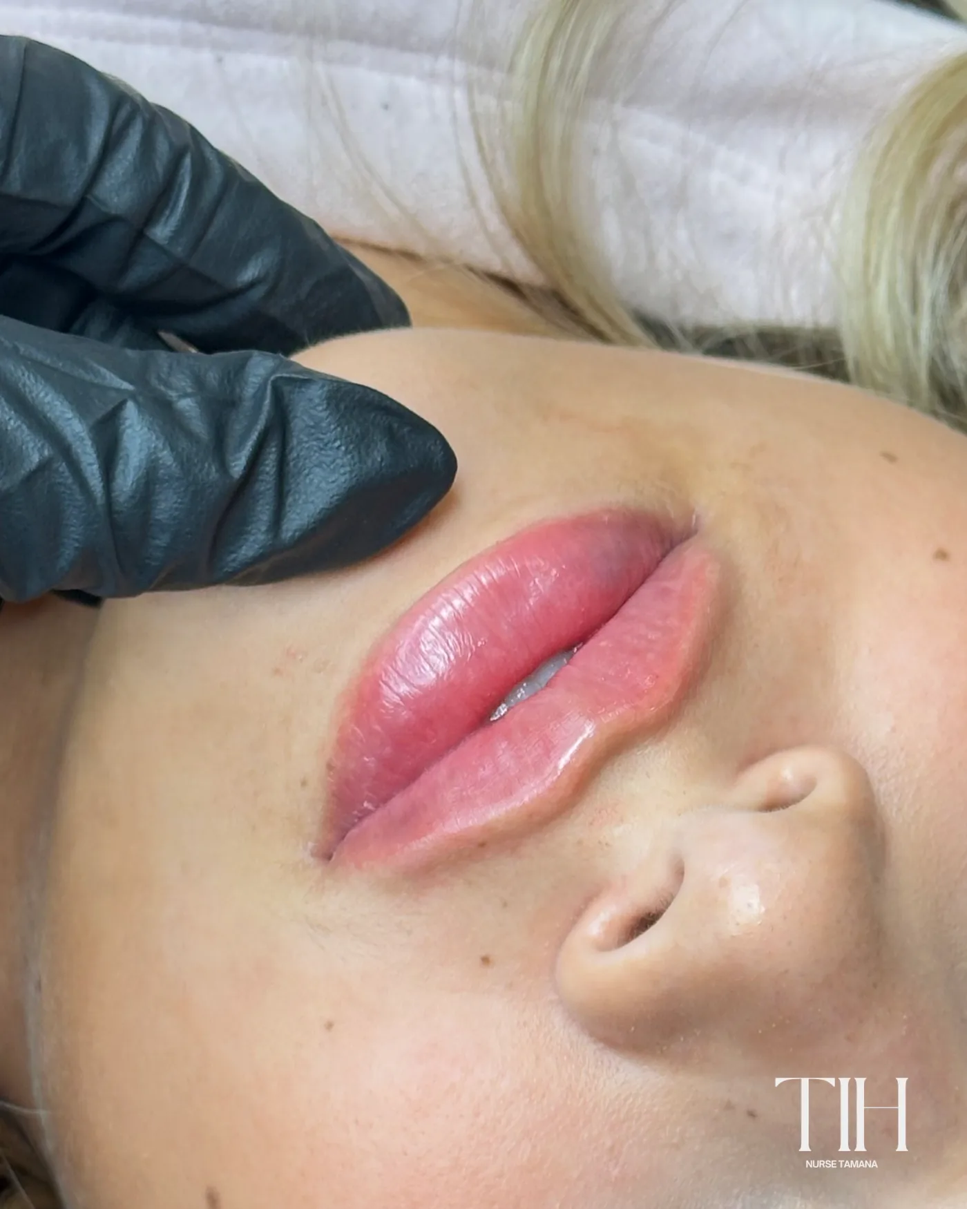 Close-up of a lip filler treatment in progress