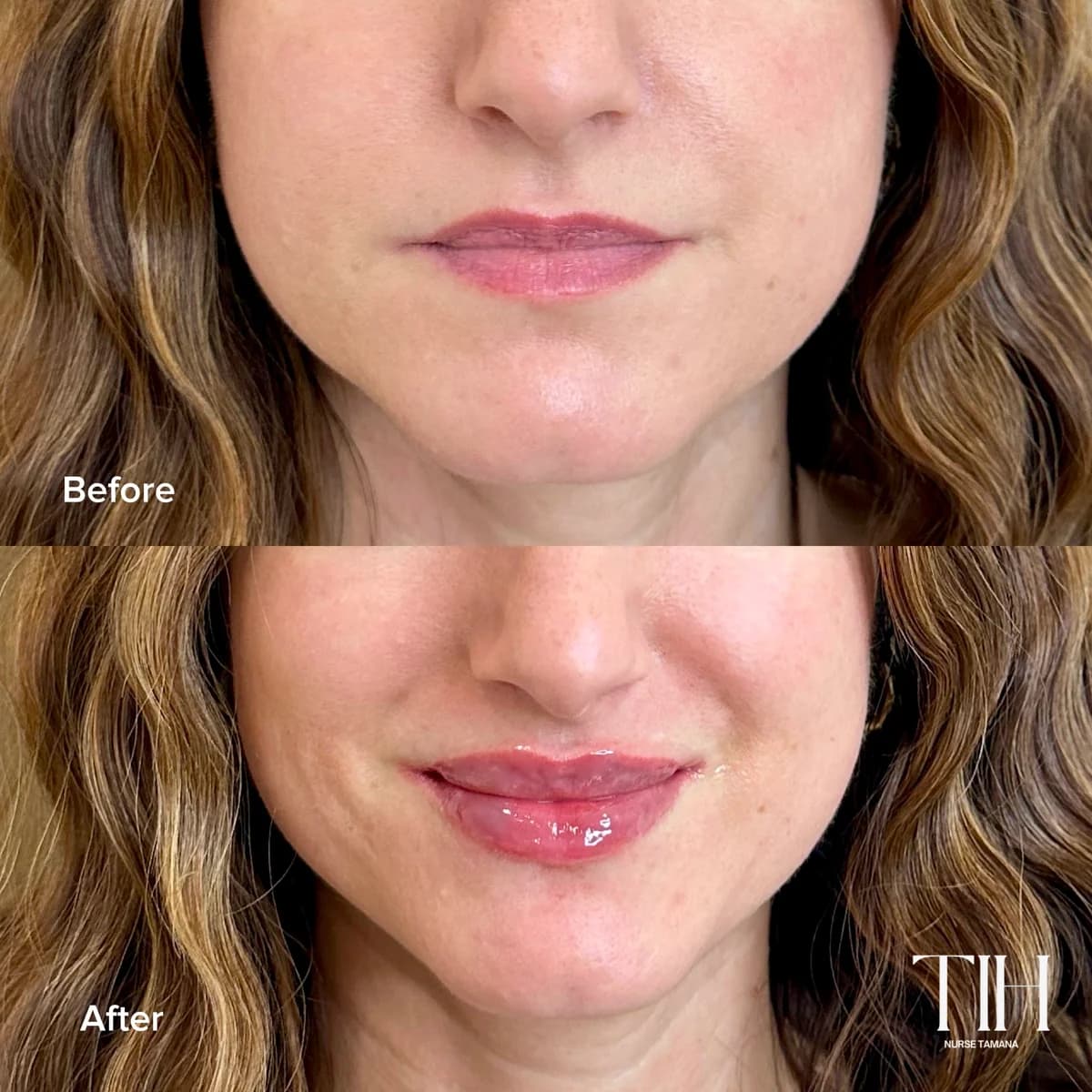 Before and after lip filler — soft hydration and definition