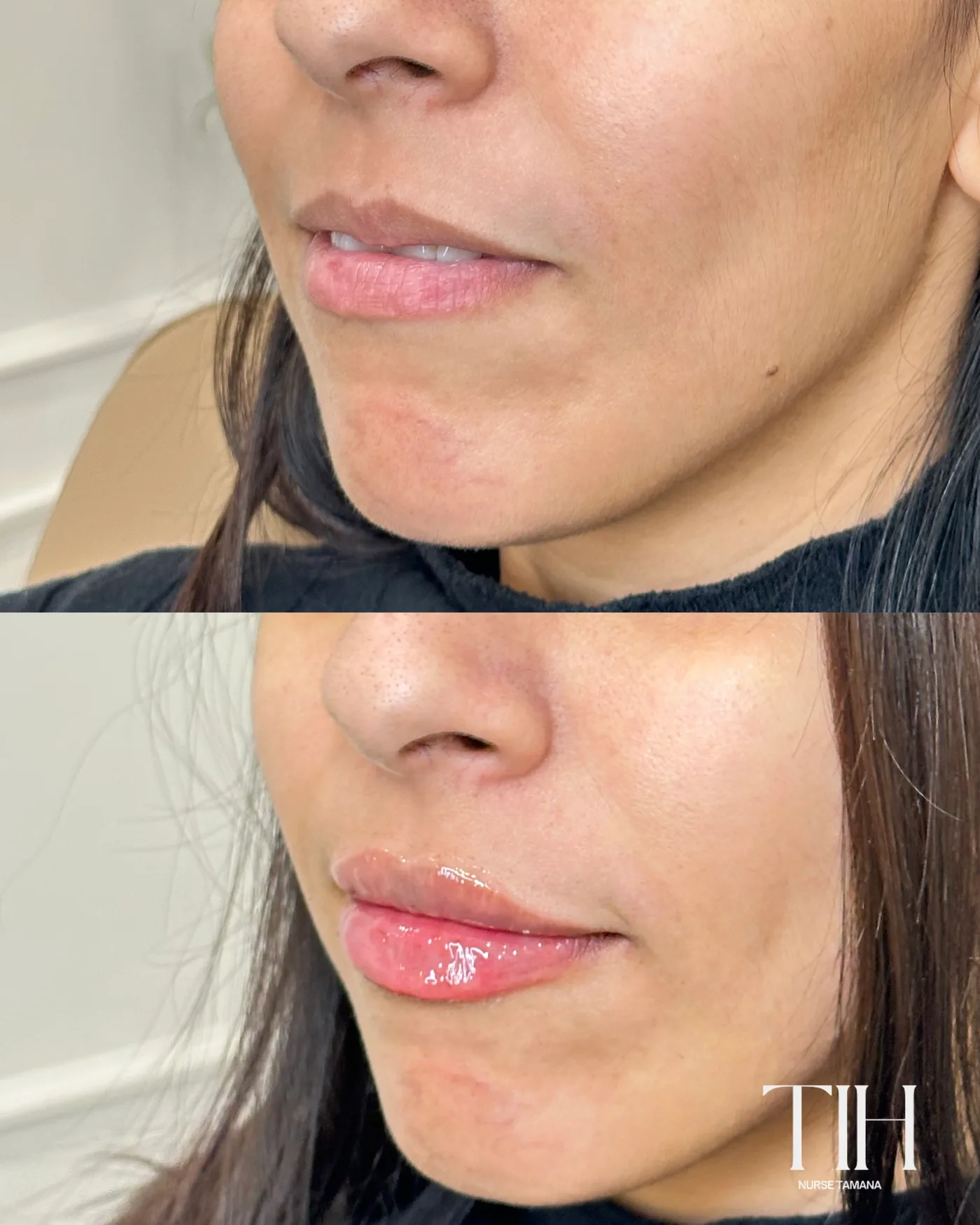 Before and after lip filler — angled view showing added volume and definition