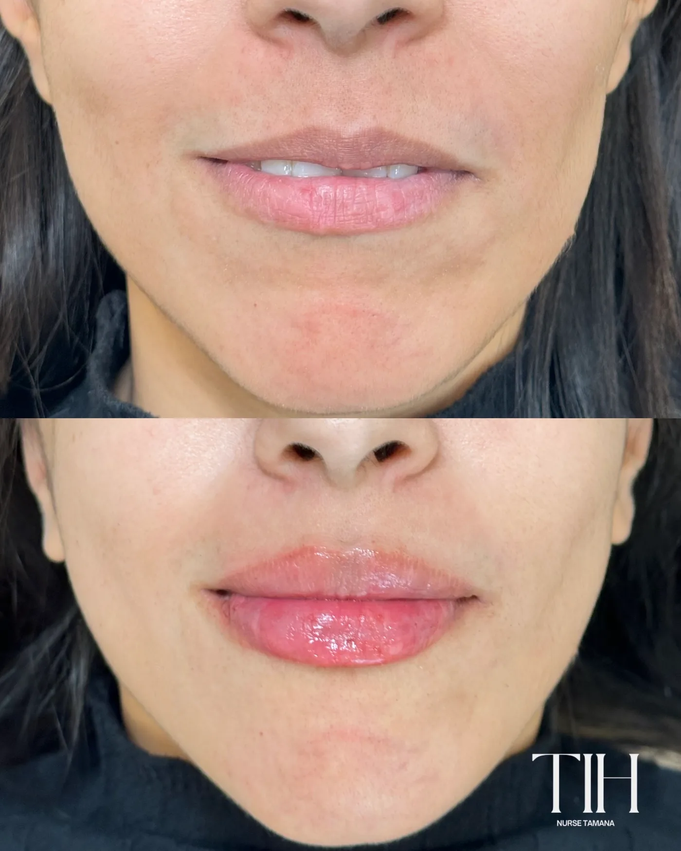 Before and after lip filler — fuller lips with soft, natural shape