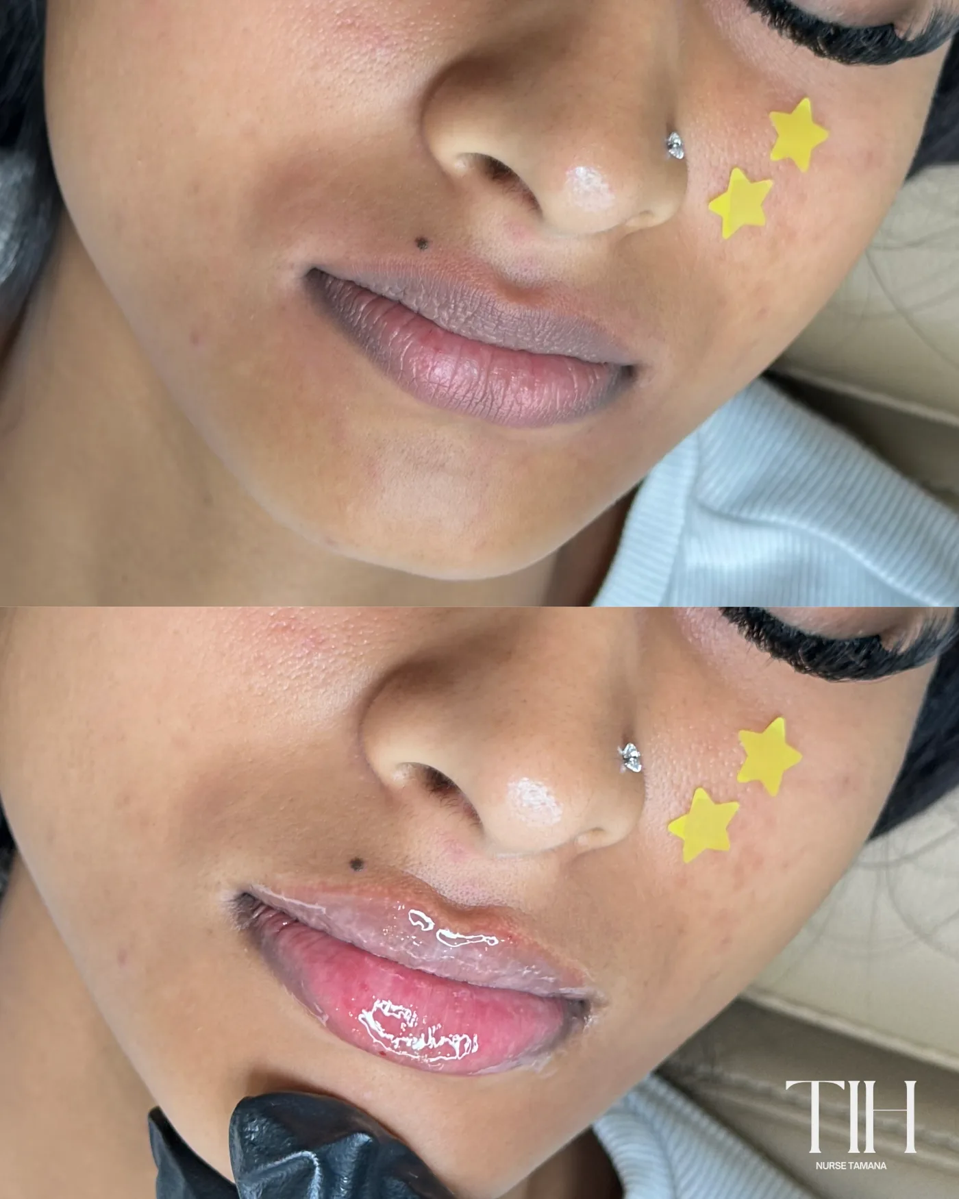 Before and after lip filler — smooth, hydrated volume
