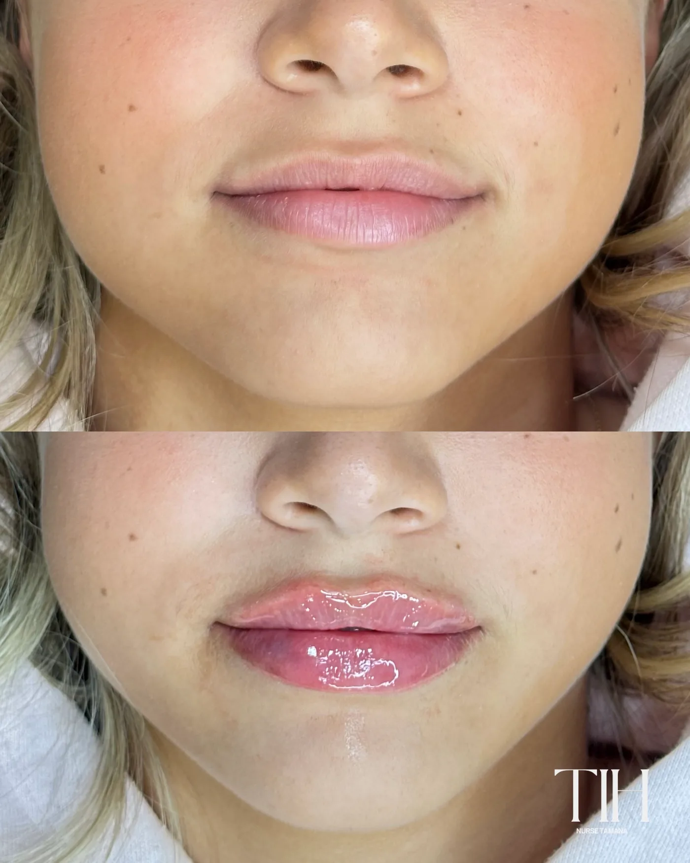 Before and after lip filler — balanced upper and lower lip volume