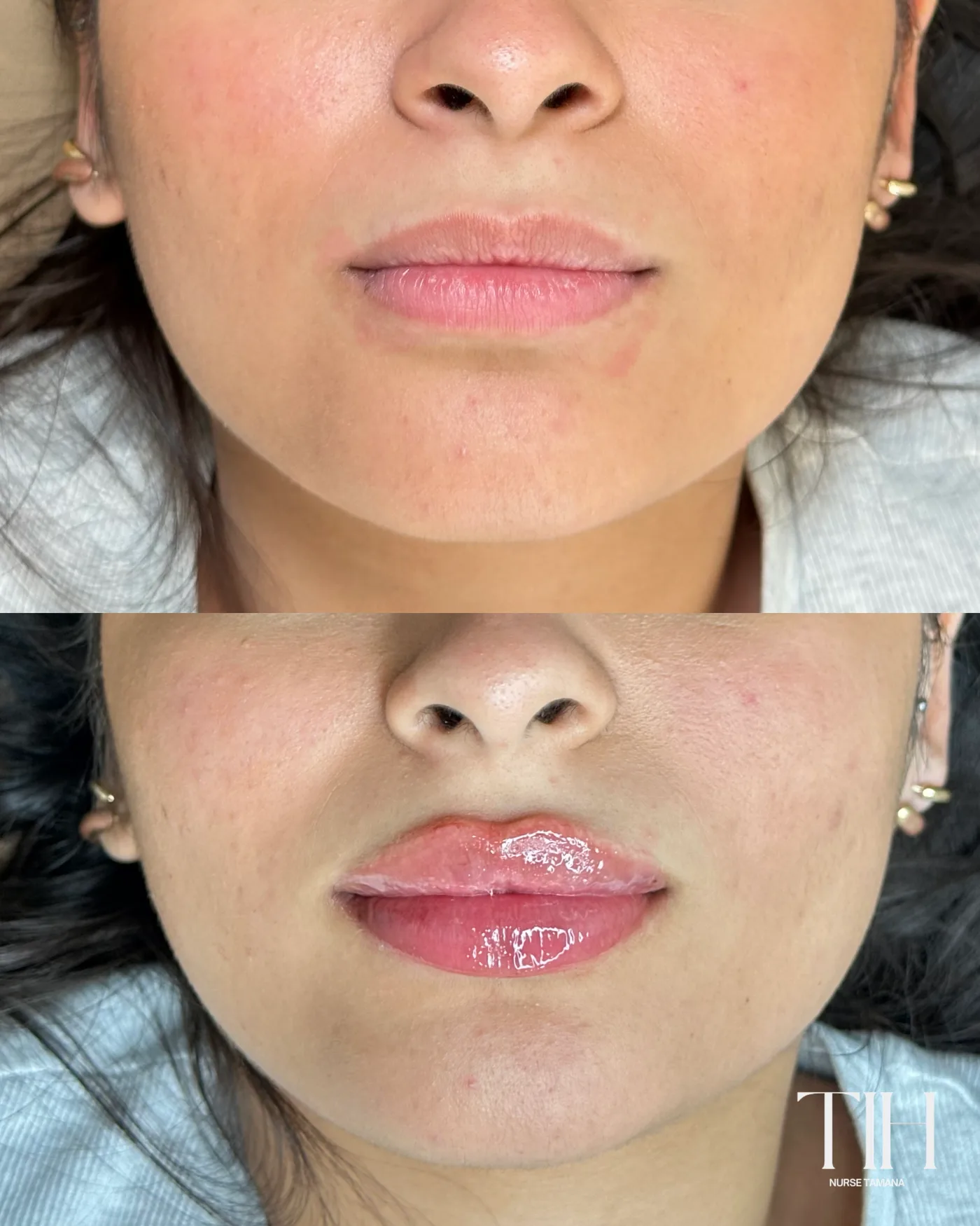 Before and after lip filler — soft, natural volume and shape