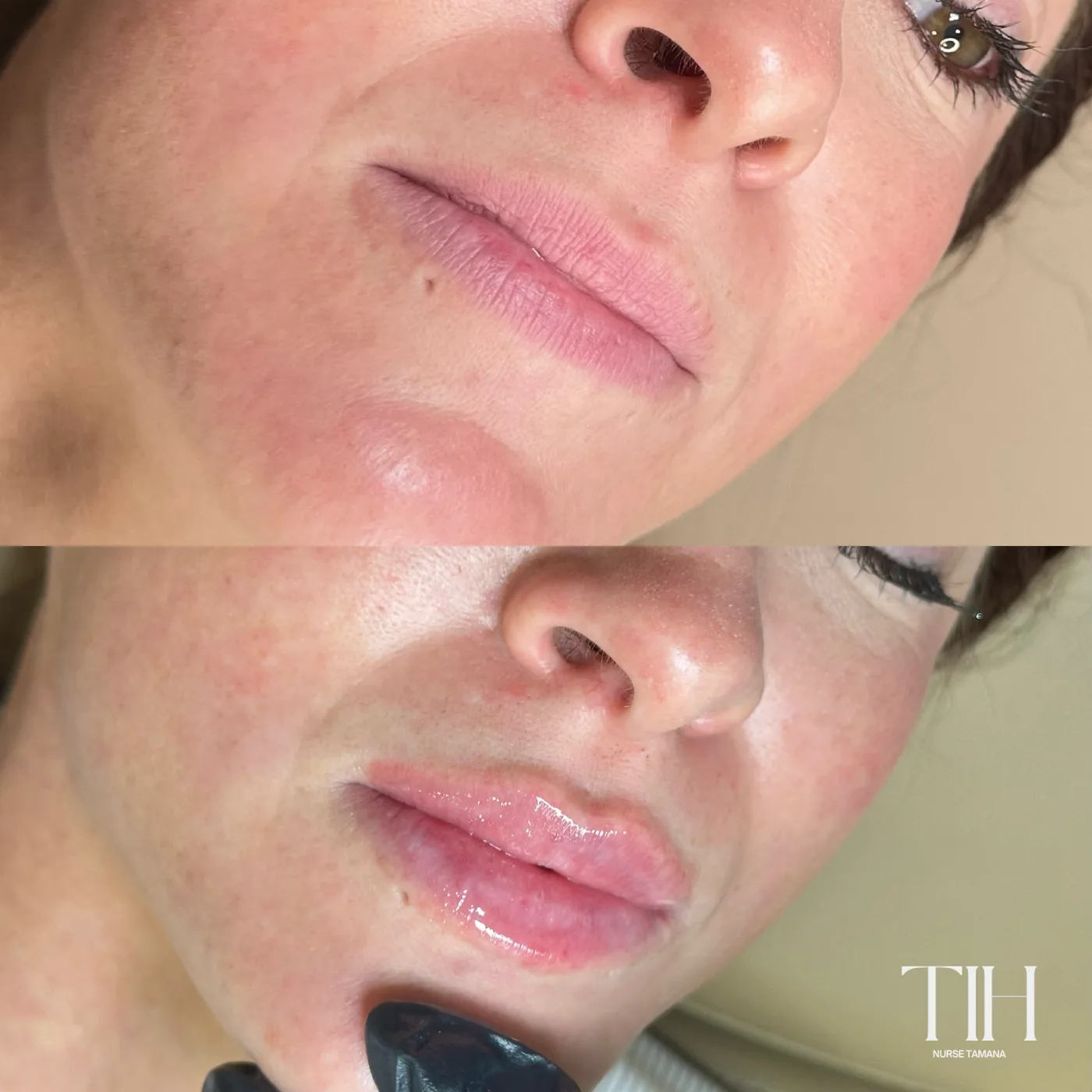 Before and after lip filler — refined shape and hydration