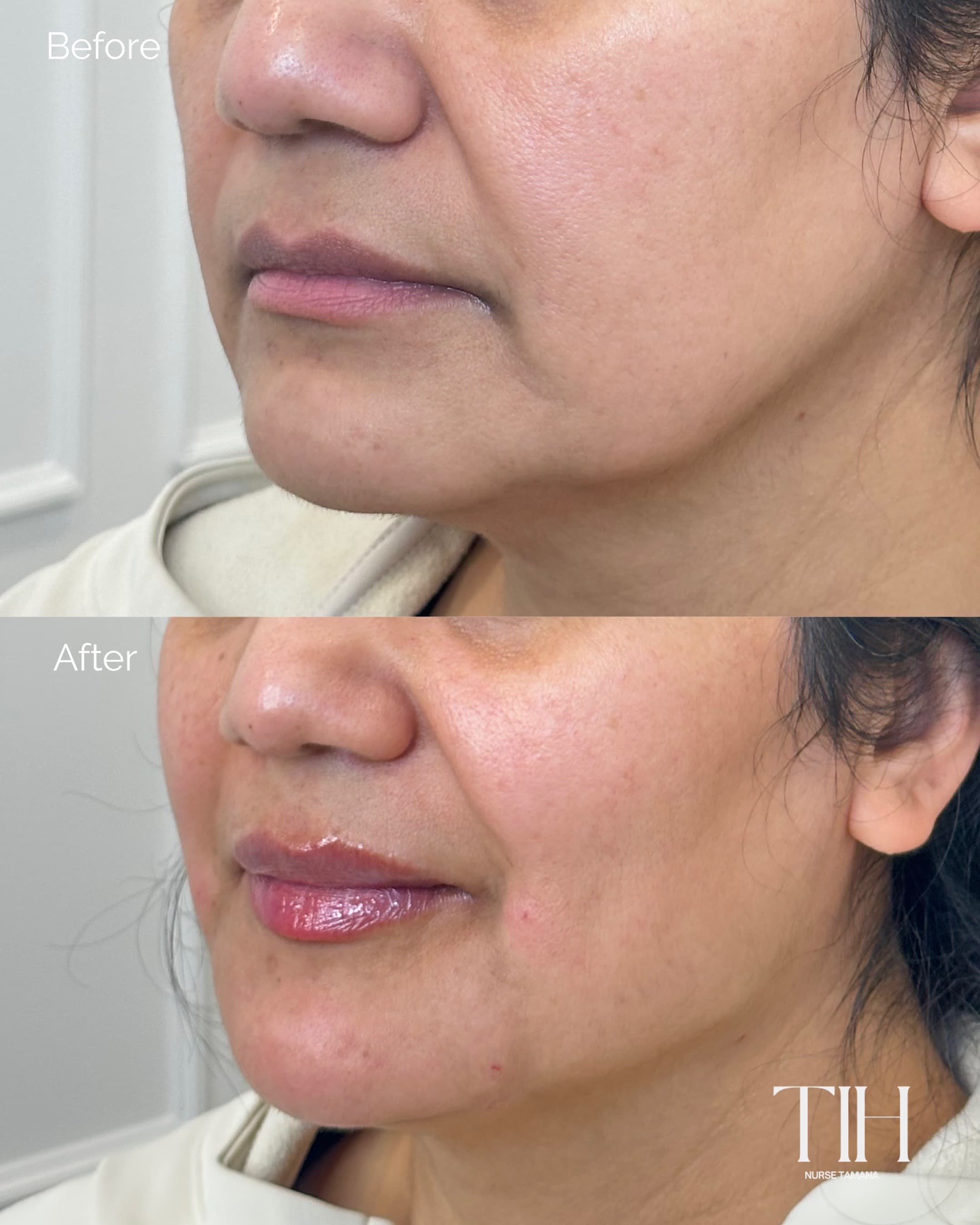 Before and after lip filler — angled view showing soft projection and shape