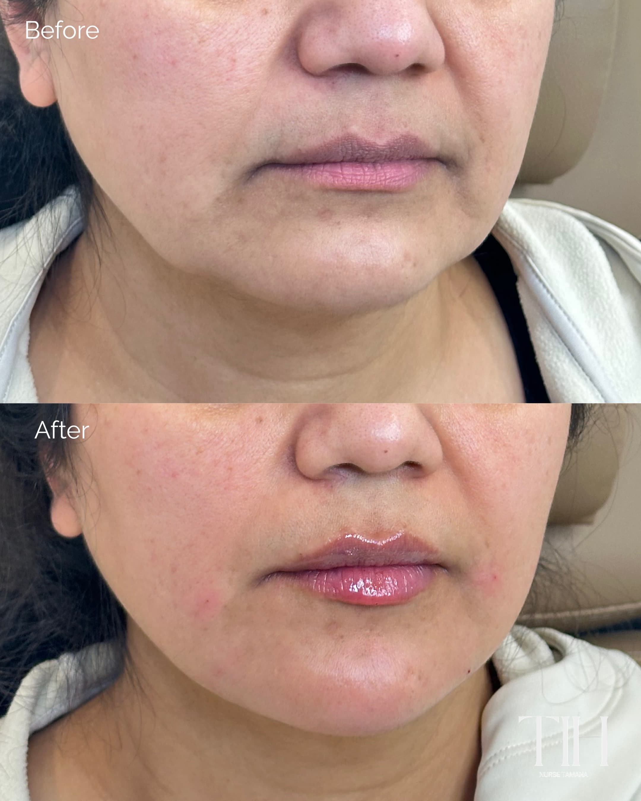 Before and after lip filler — alternate frontal view showing natural-looking volume