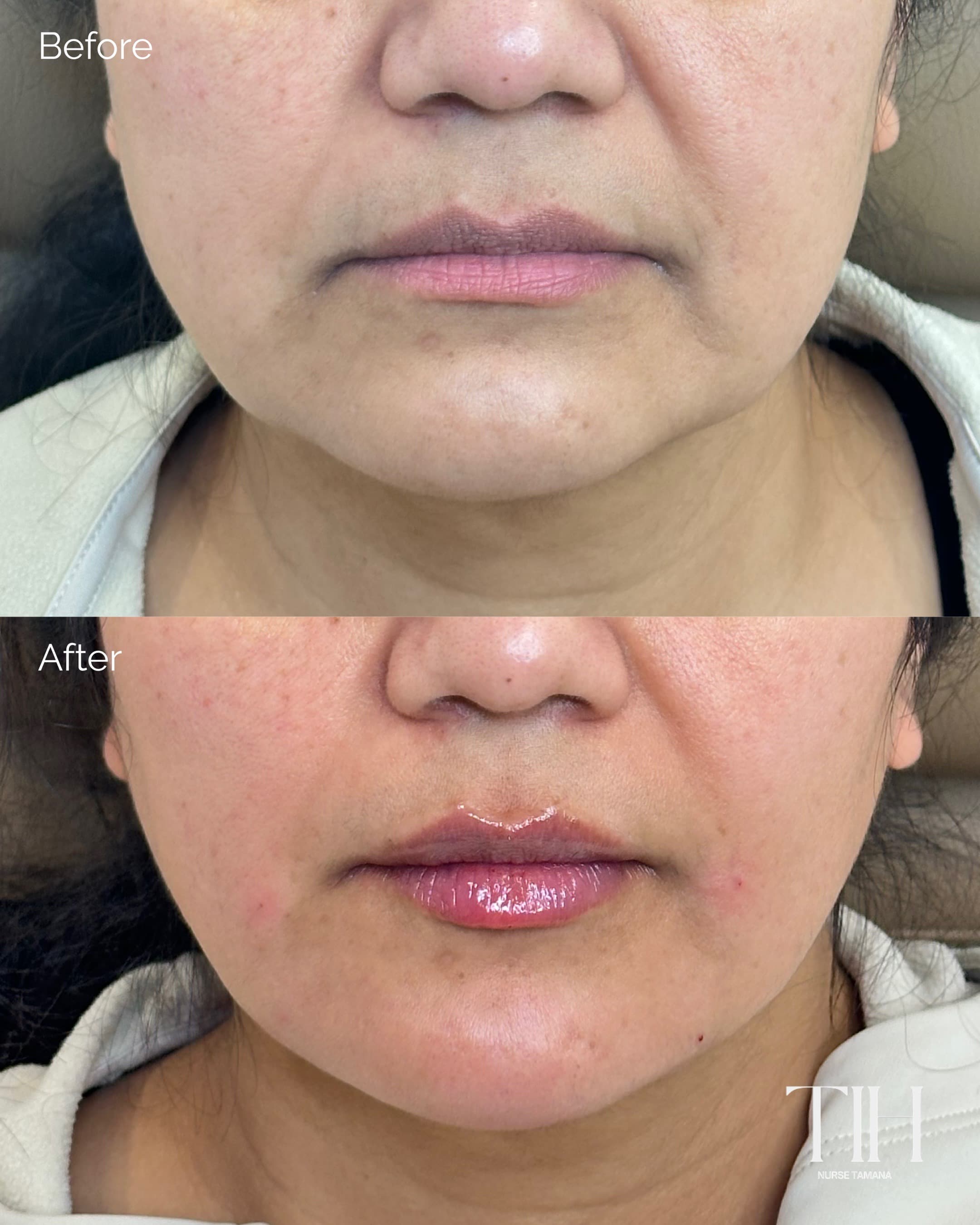 Before and after lip filler — frontal view showing balanced volume and definition