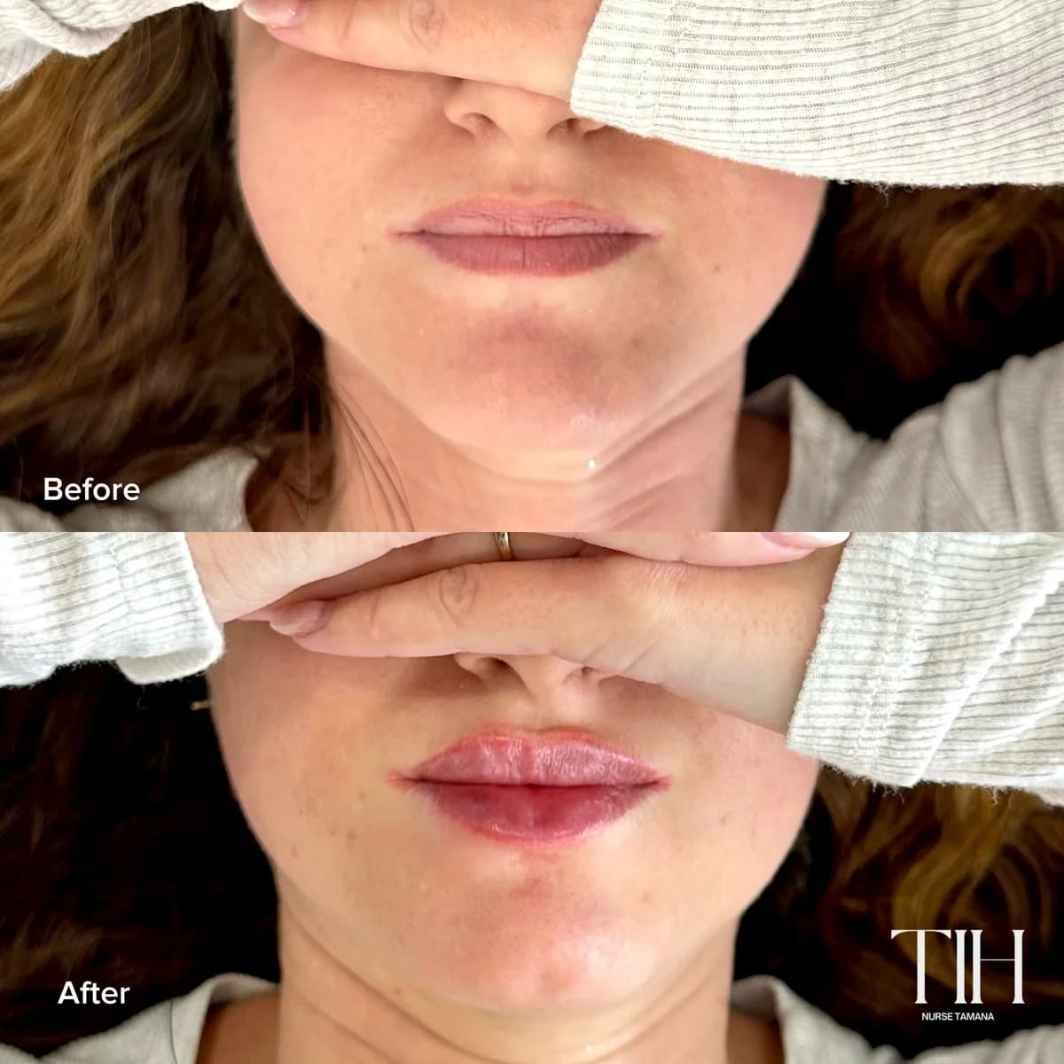 Before and after lip filler — subtle shape refinement