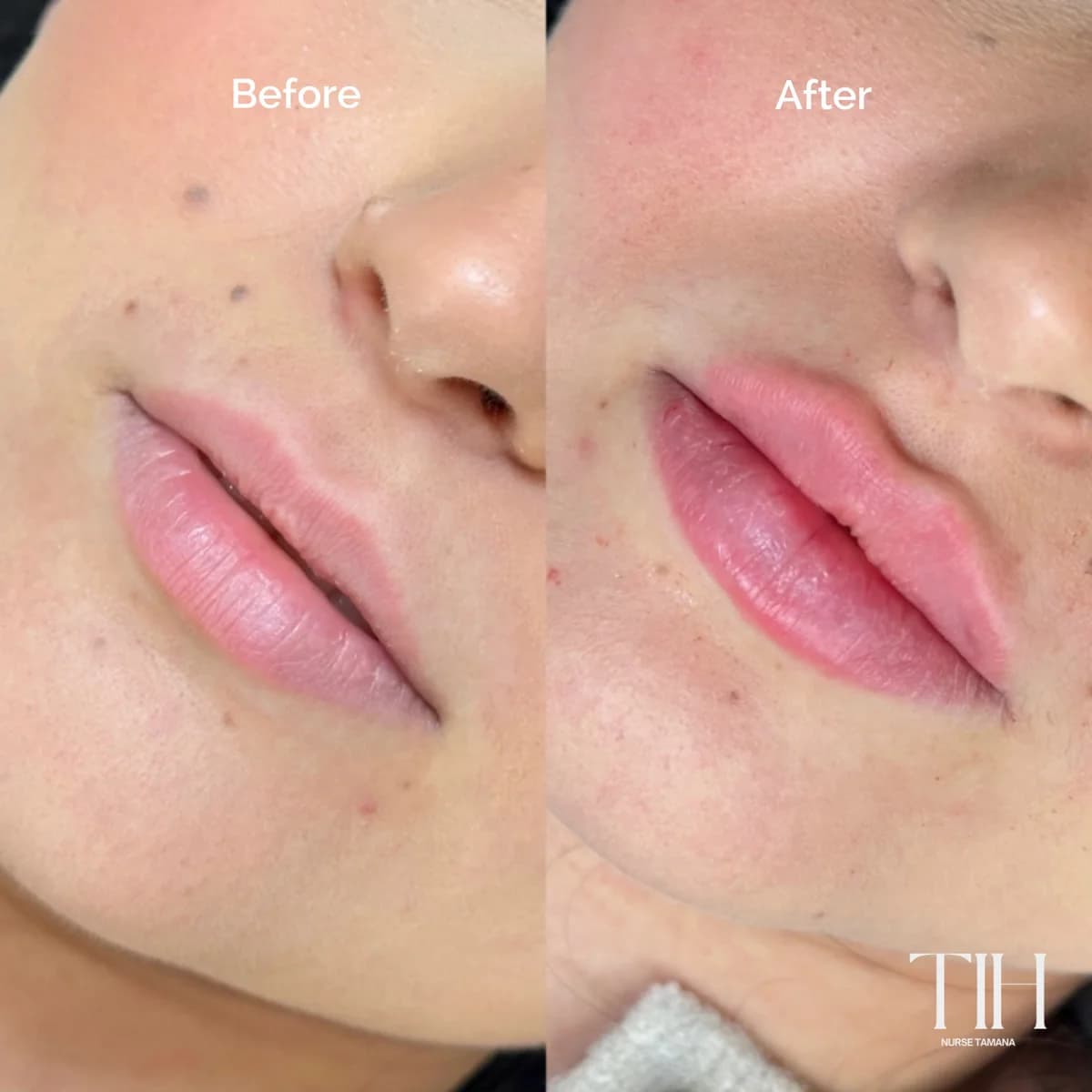 Before and after lip filler — balanced volume and symmetry