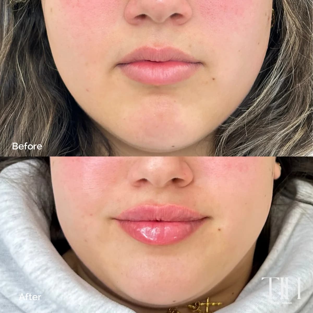 Before and after lip filler — natural-looking enhancement