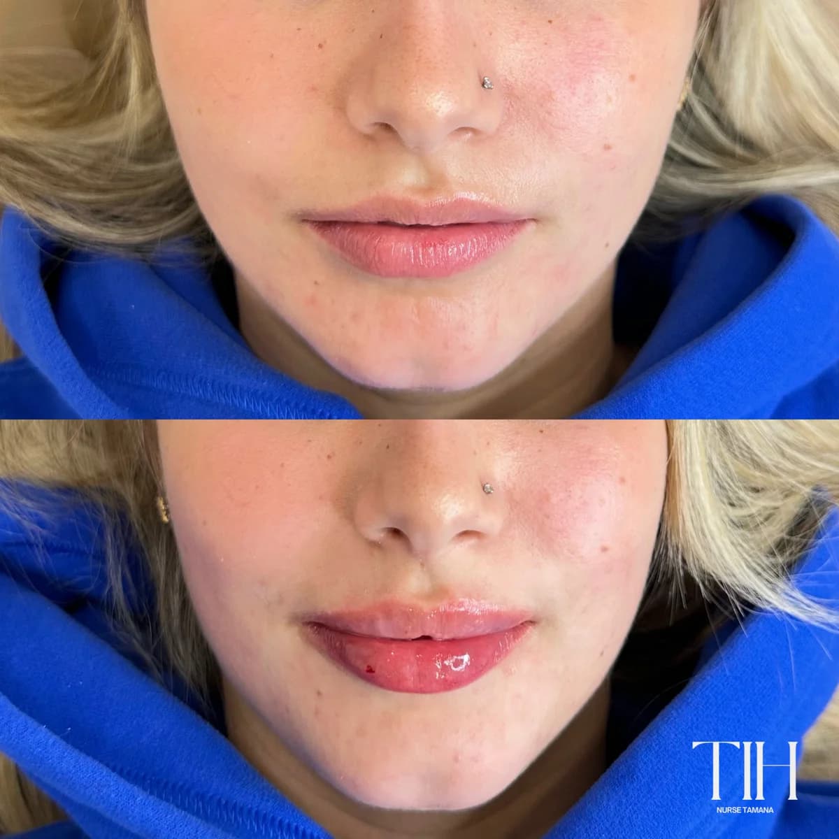 Before and after natural lip filler result