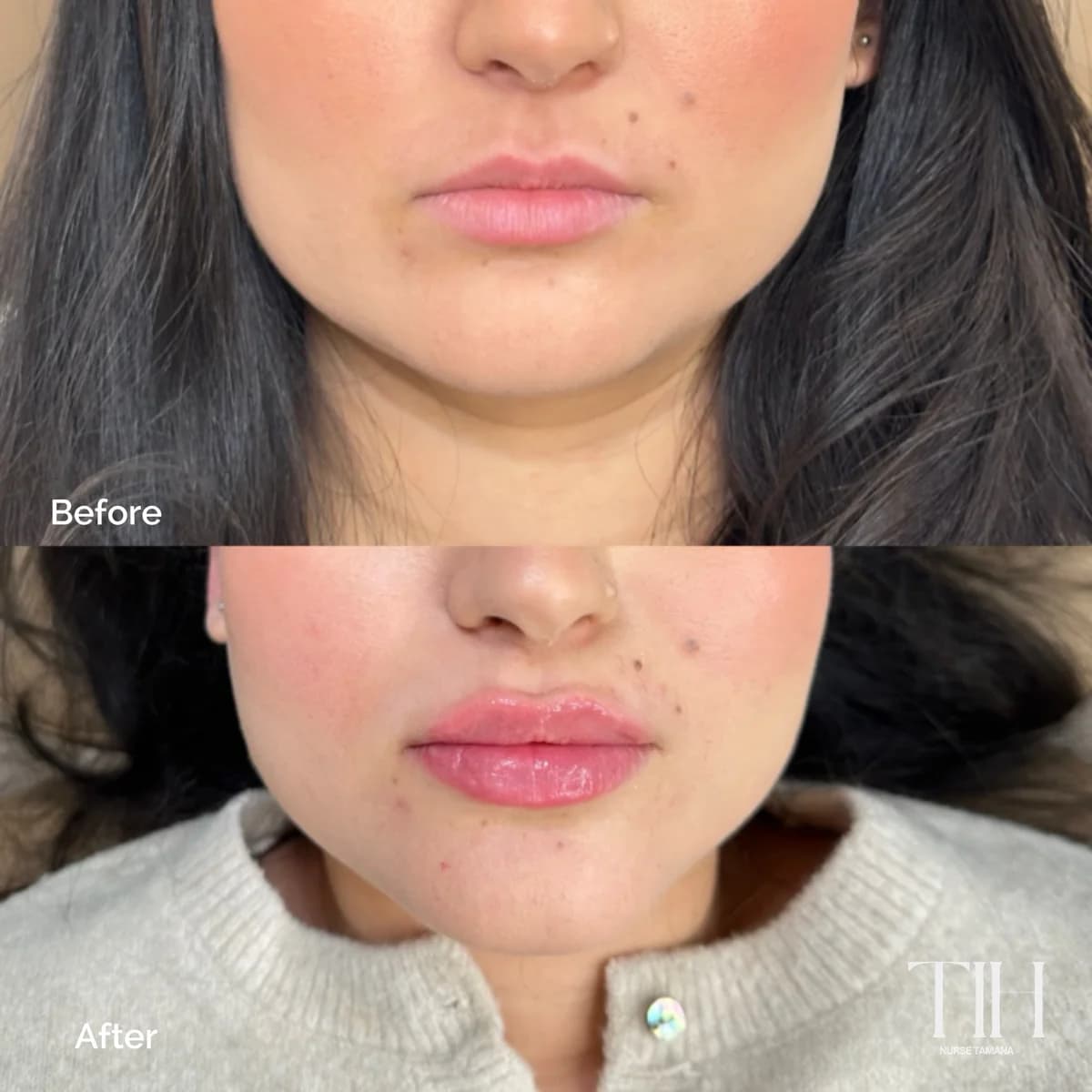 Before and after lip filler showing shape and definition