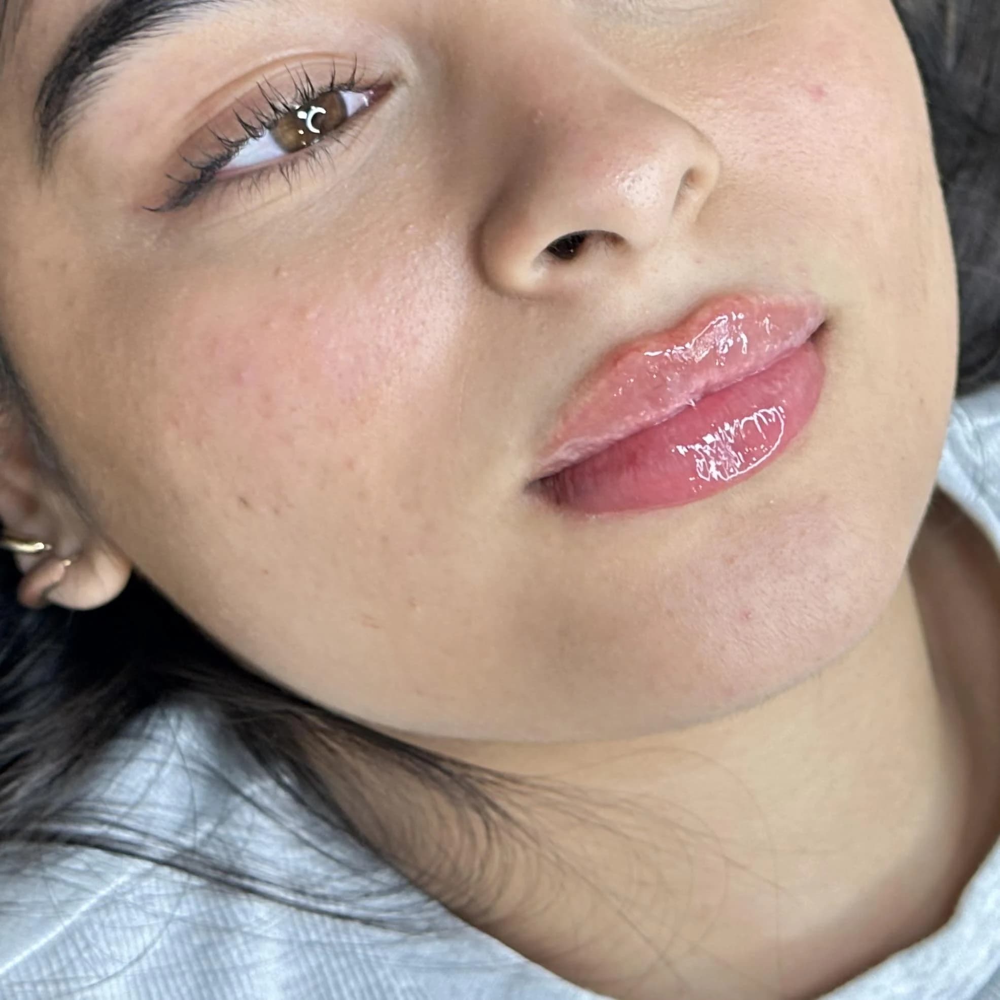 Lip Filler at The Injectable Haus