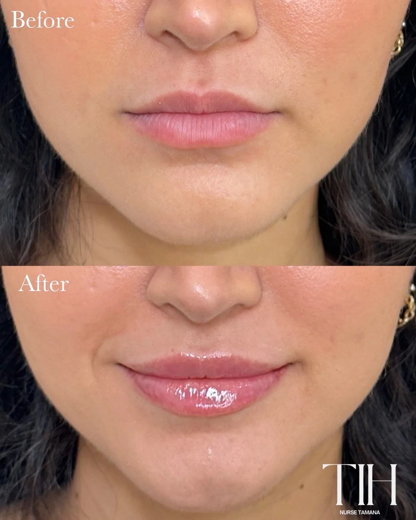 Before and after lip filler — fuller, natural-looking volume